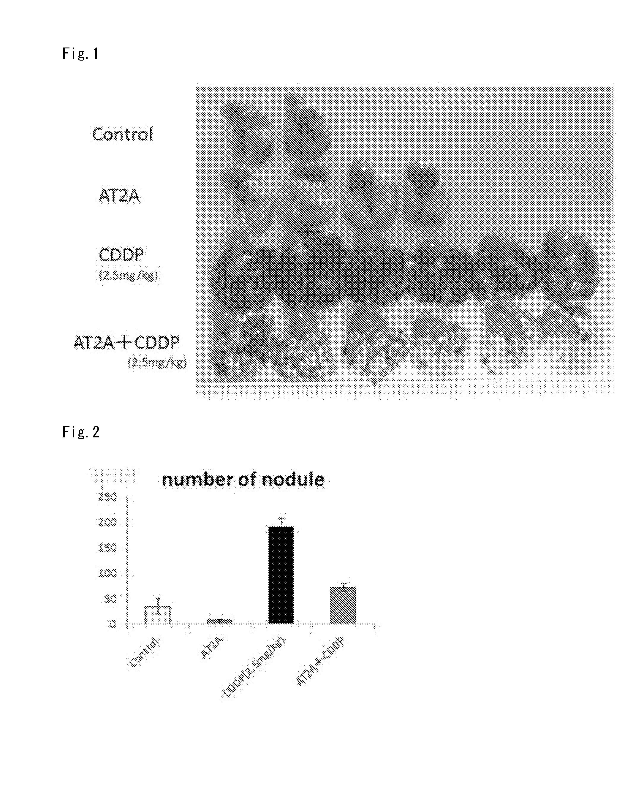 Medicament for suppressing malignant tumor metastasis