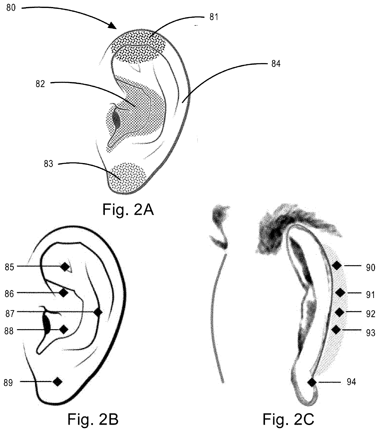 Multimodal Transcutaneous Auricular Stimulation System Including Methods and Apparatus for Self Treatment, Feedback Collection and Remote Therapist Control