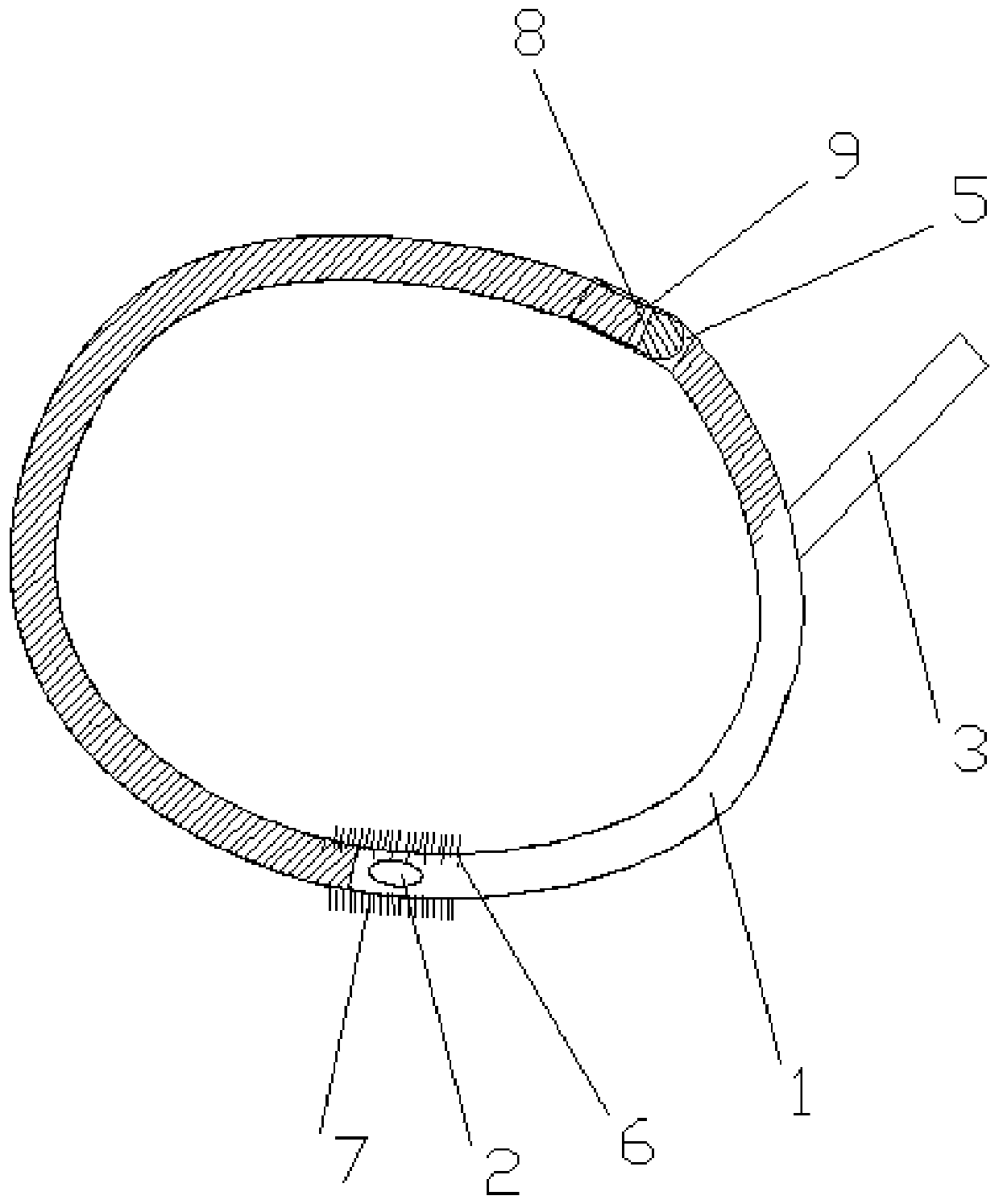 An anal fistula flushing floating thread