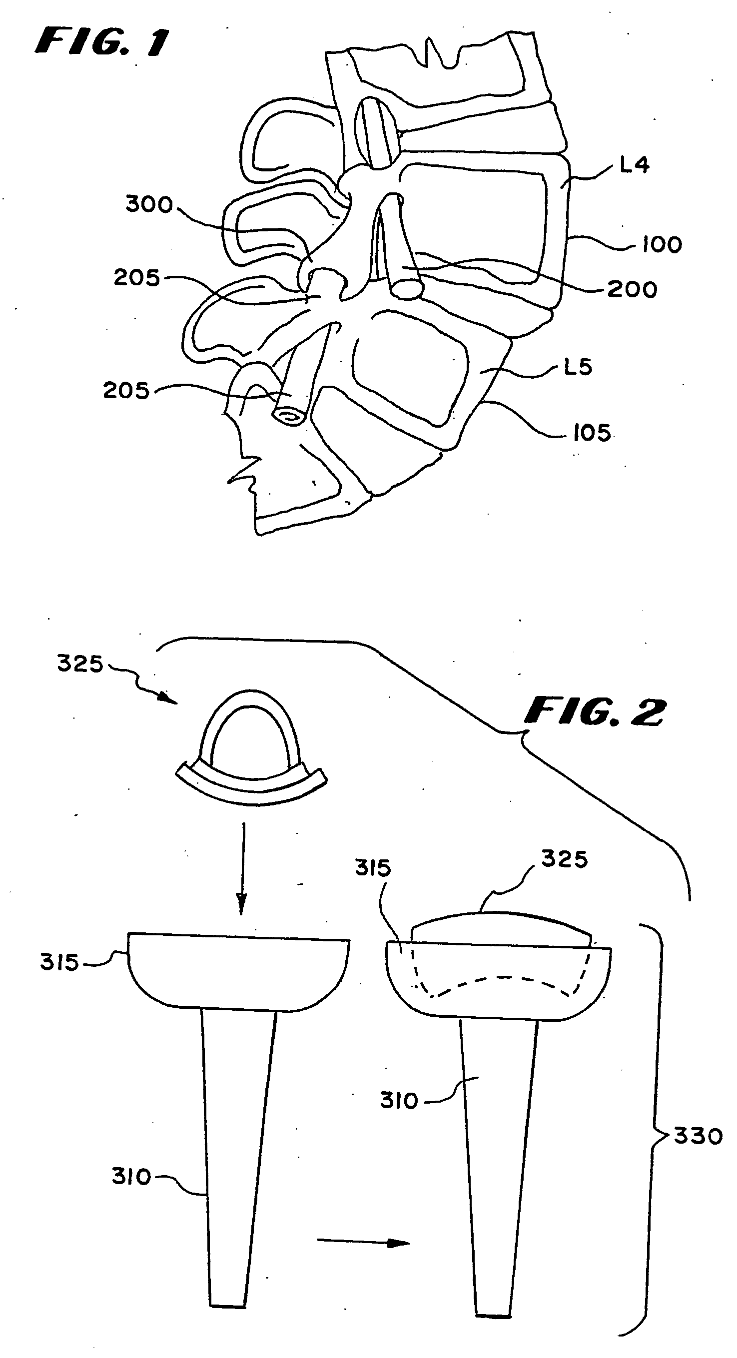 Facet arthroplasty devices and methods