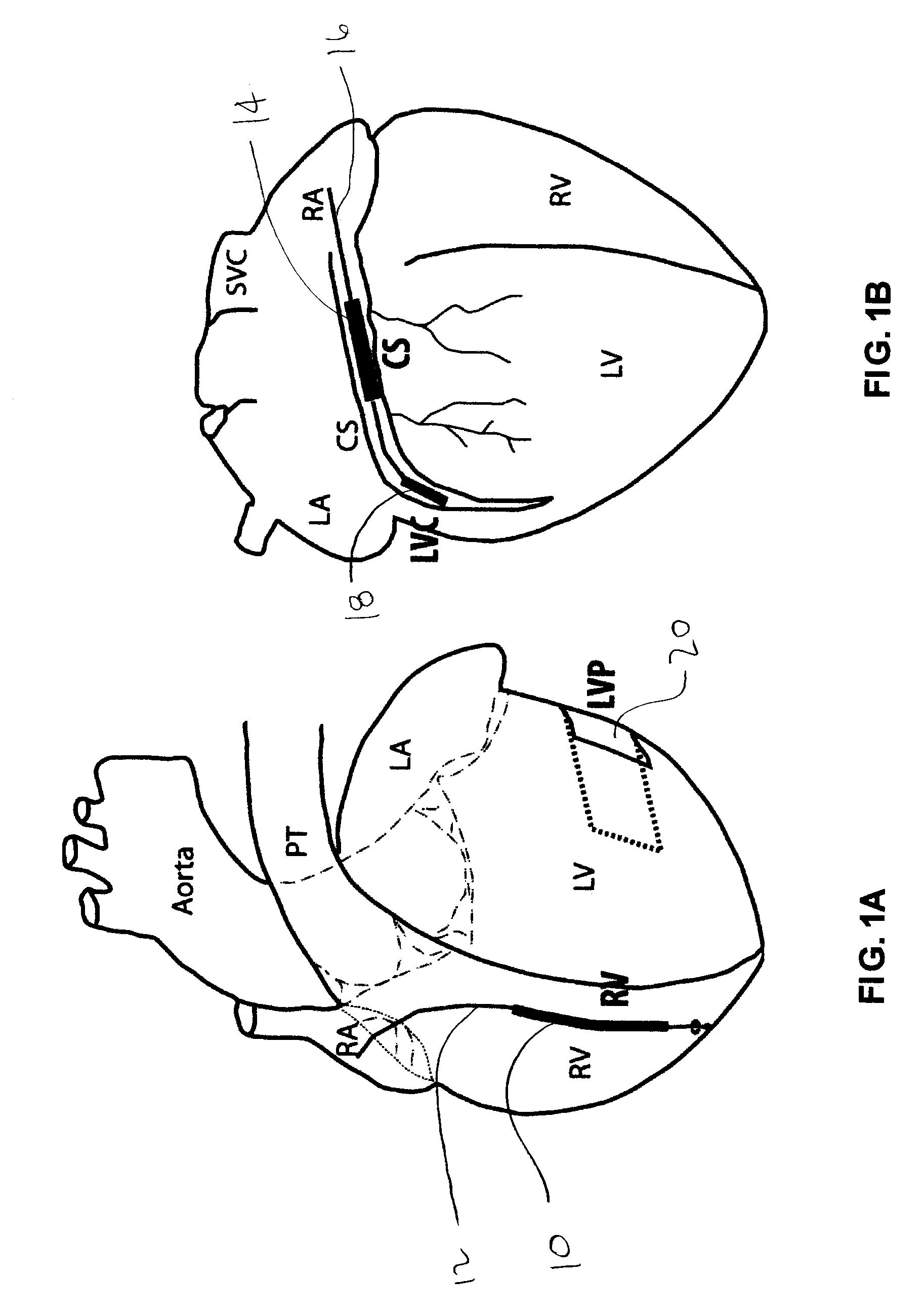 Methods and devices for three-stage ventricular therapy