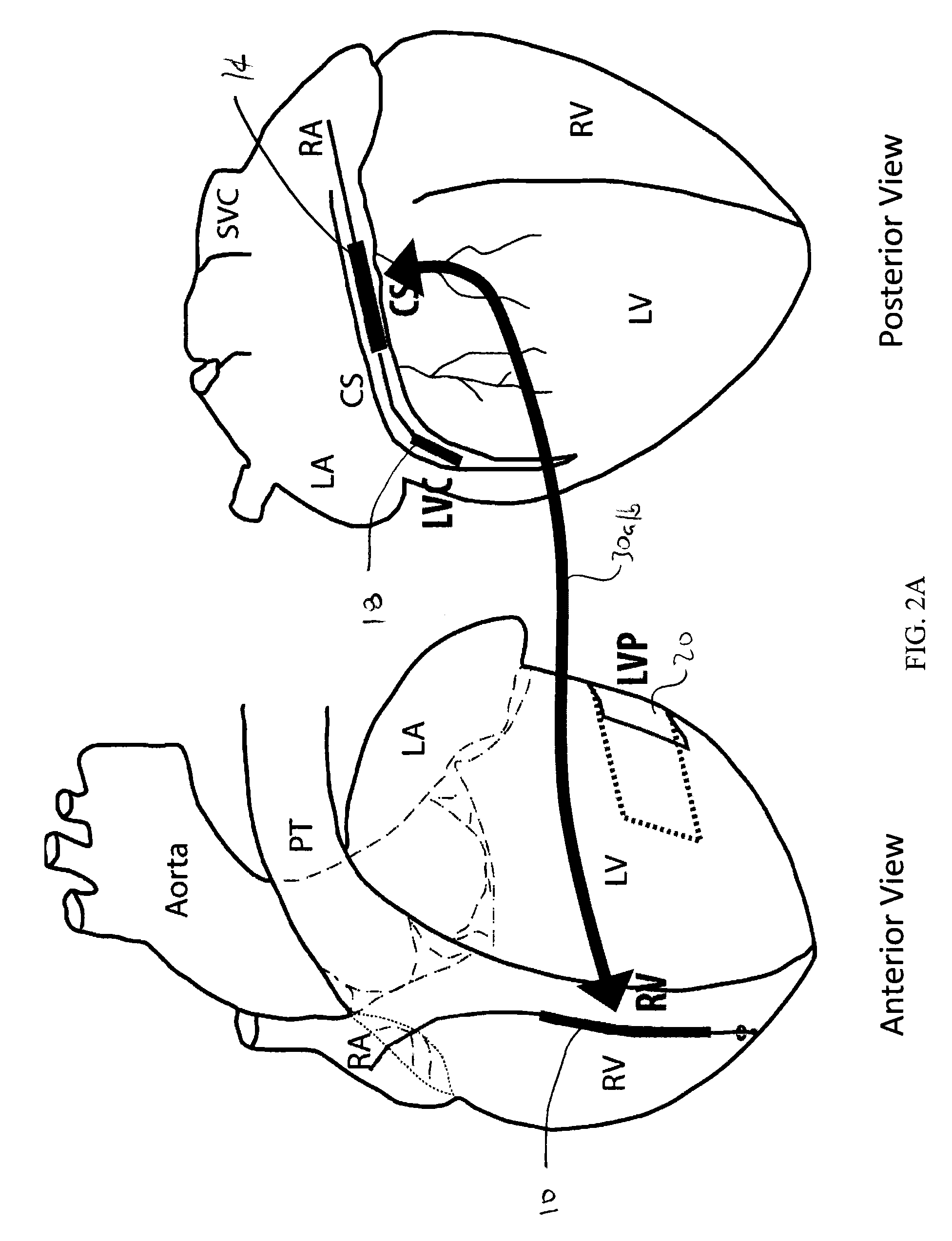 Methods and devices for three-stage ventricular therapy