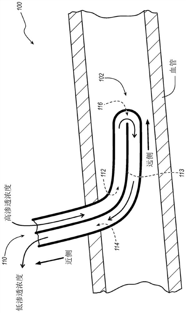 Catheters, catheter-based systems, and methods thereof for treating hypervolemia