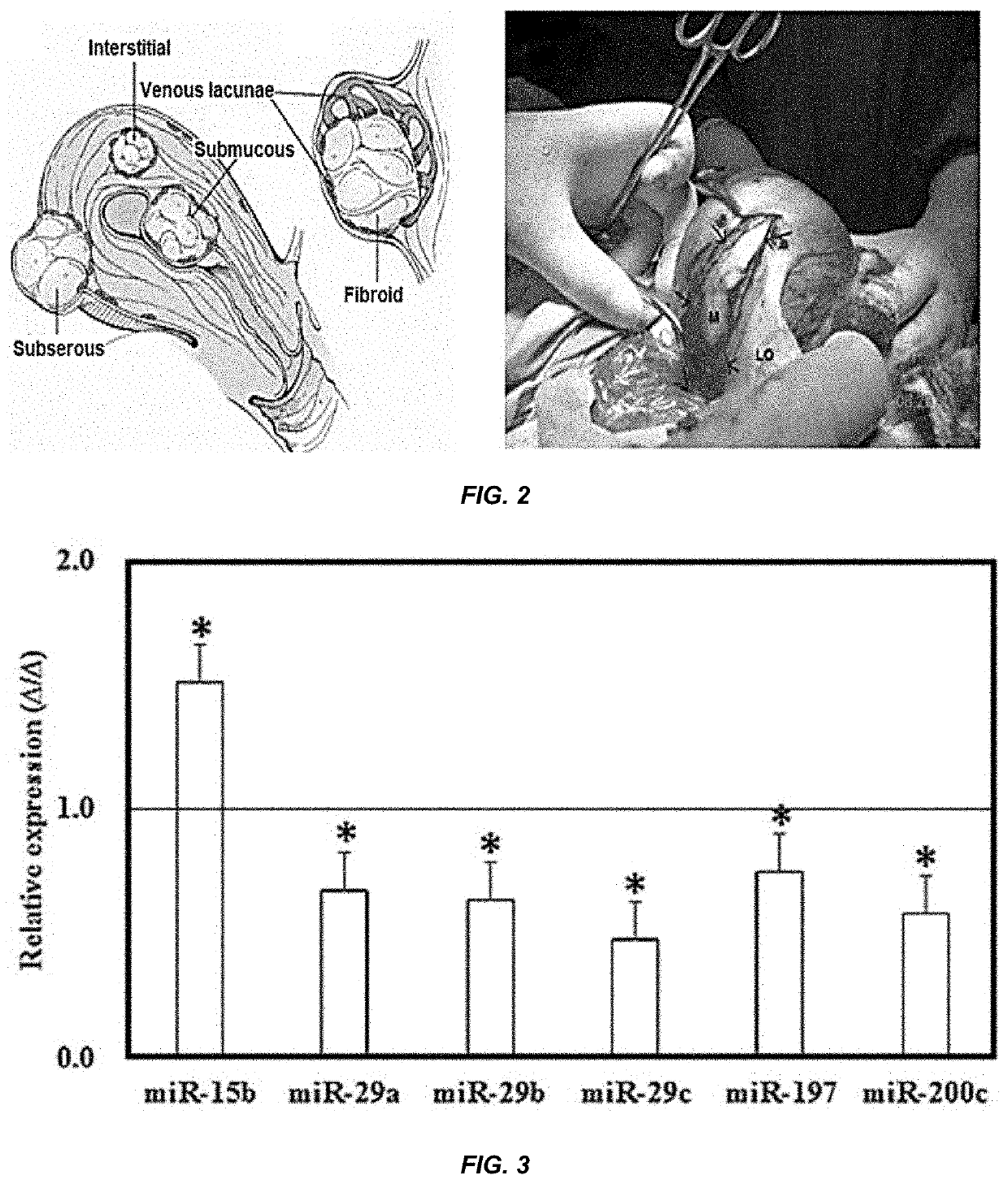 Diagnostic and treatment method for endometrial cavity distorting uterine leiomyoma using microrna