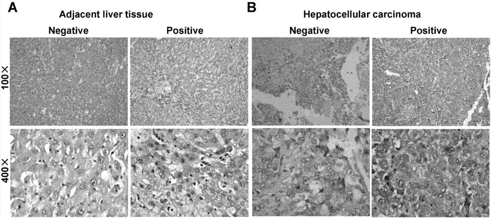 A kit for hepatocellular carcinoma auxiliary diagnosis or disease surveillance and applications