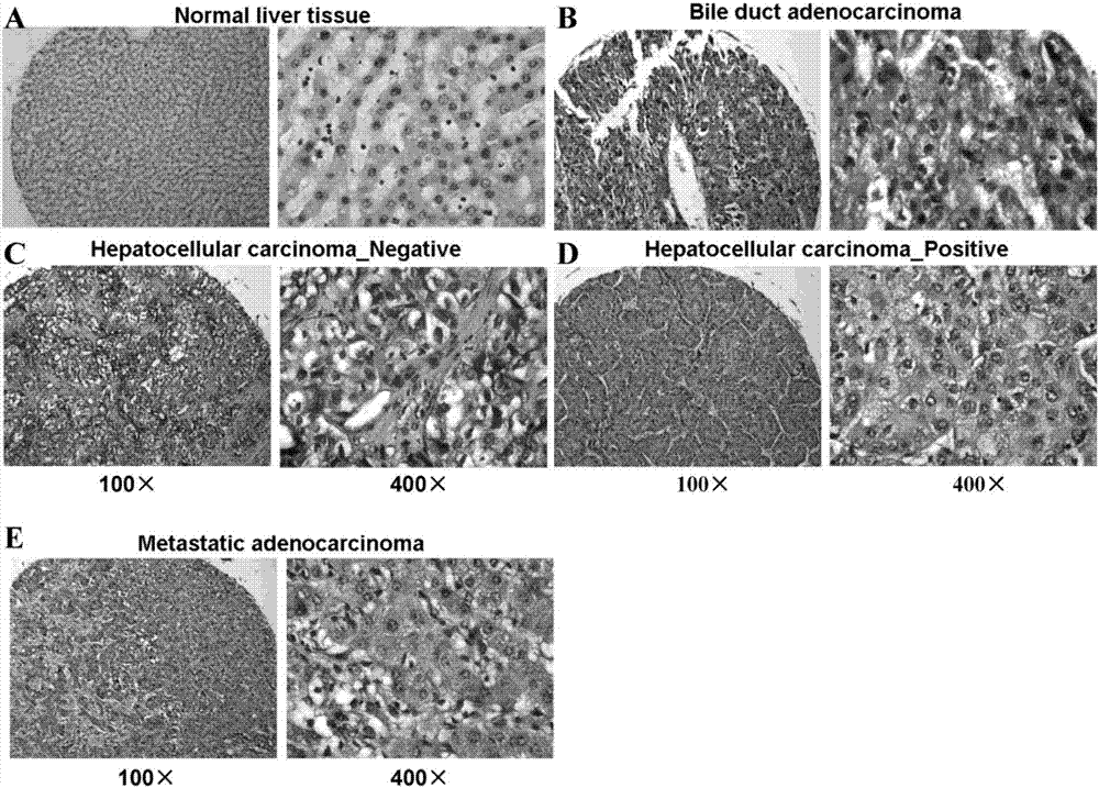 A kit for hepatocellular carcinoma auxiliary diagnosis or disease surveillance and applications