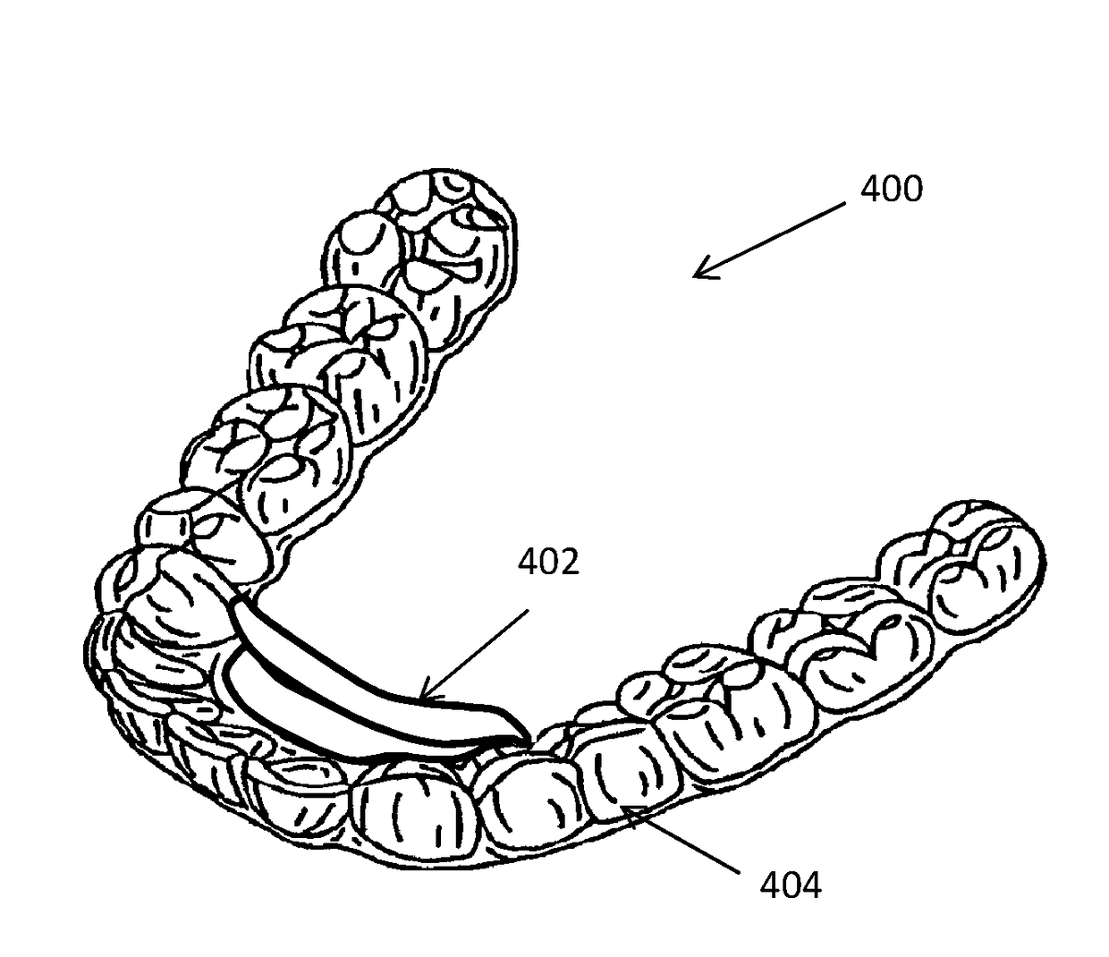 Dental appliance features for speech enhancement