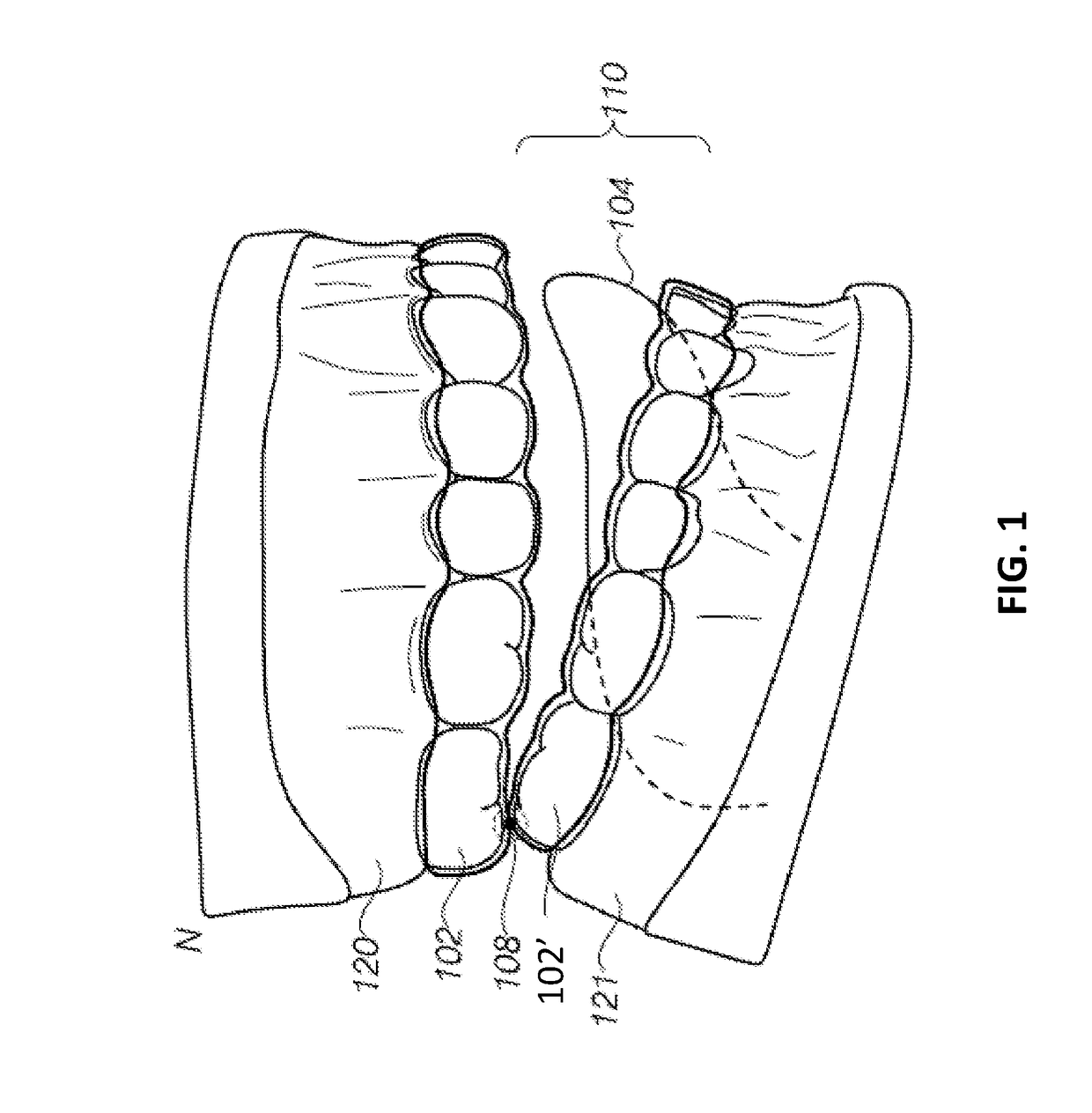 Dental appliance features for speech enhancement