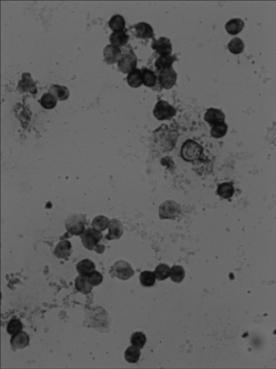 Horizontal in-situ hybridization detection kit and detection method as well as application for MICRORNA17-3P in earlier stage of cancer pathologic evolution