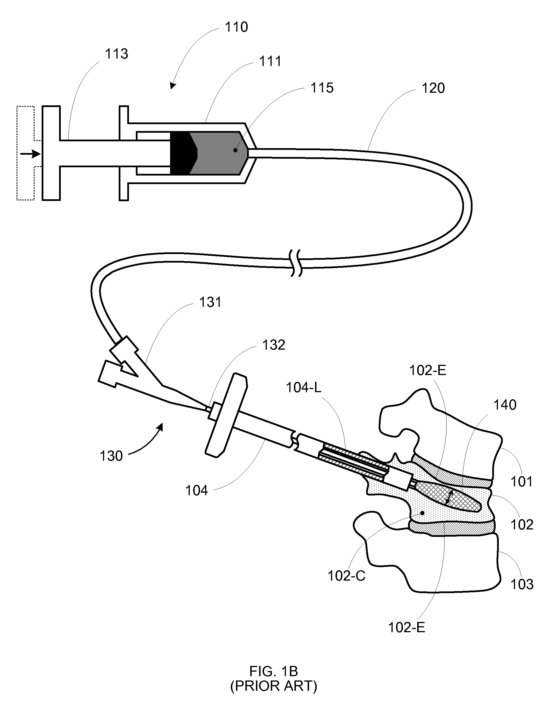 Anterior inflation balloon