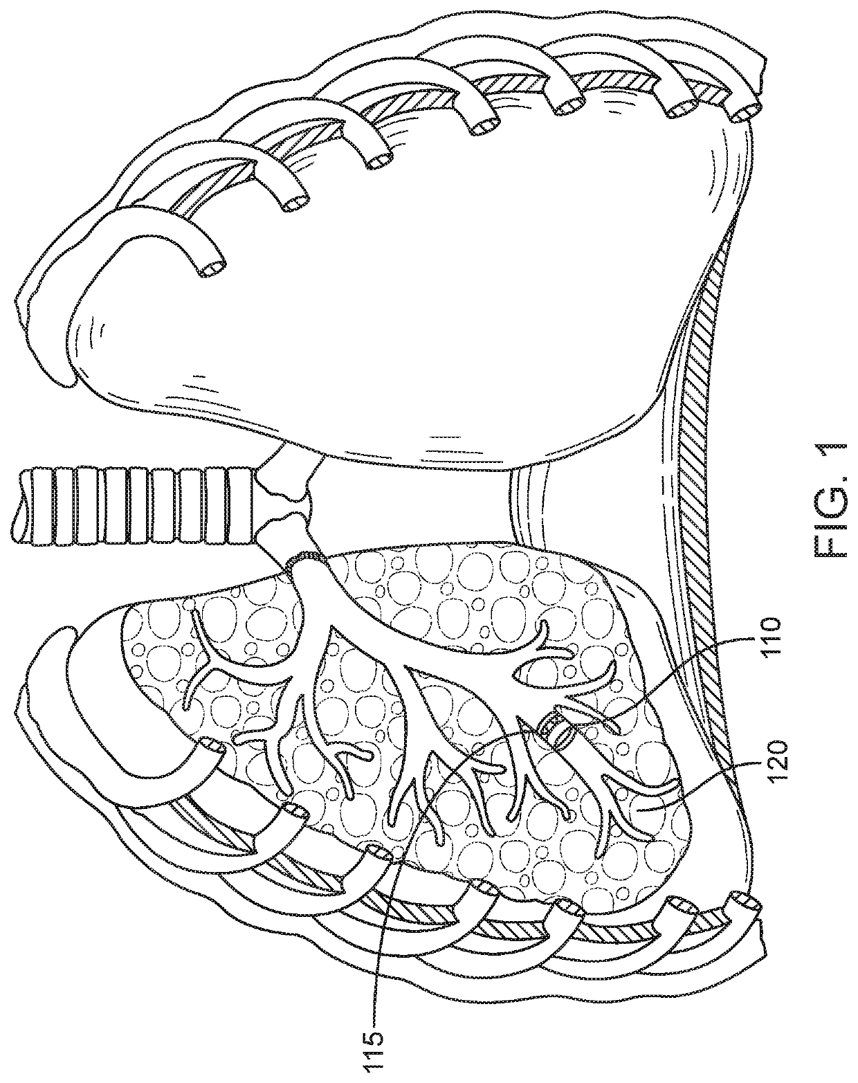 High resistance implanted bronchial isolation devices and methods