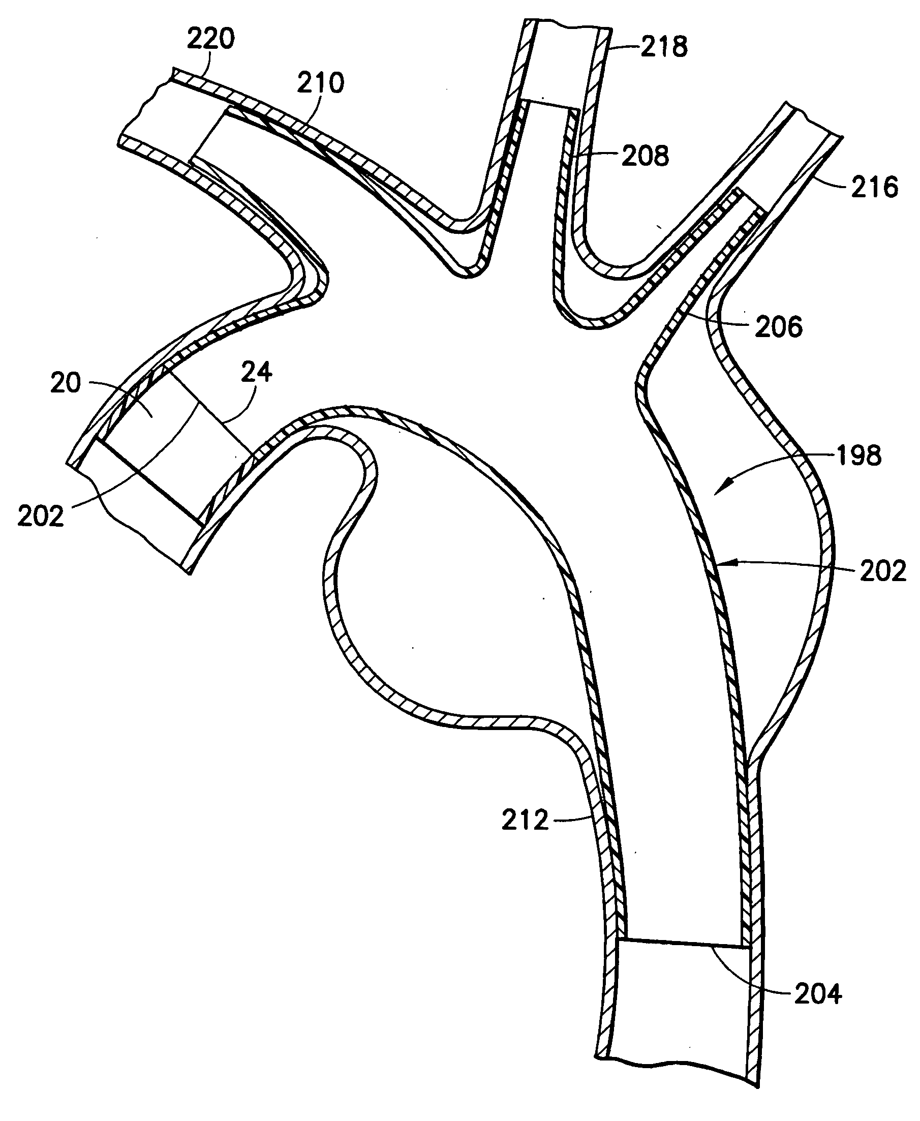 Stent/graft assembly