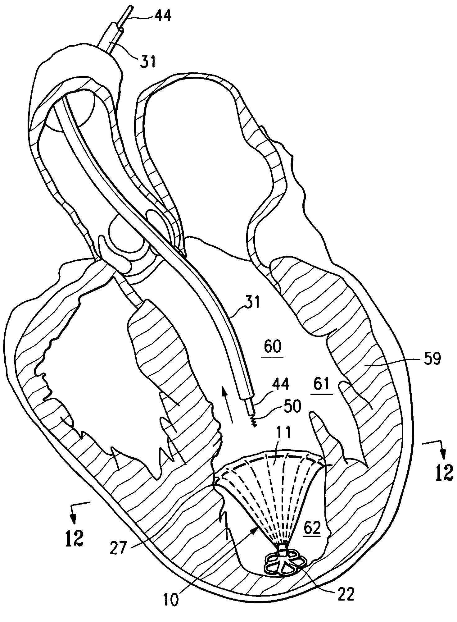 Peripheral seal for a ventricular partitioning device