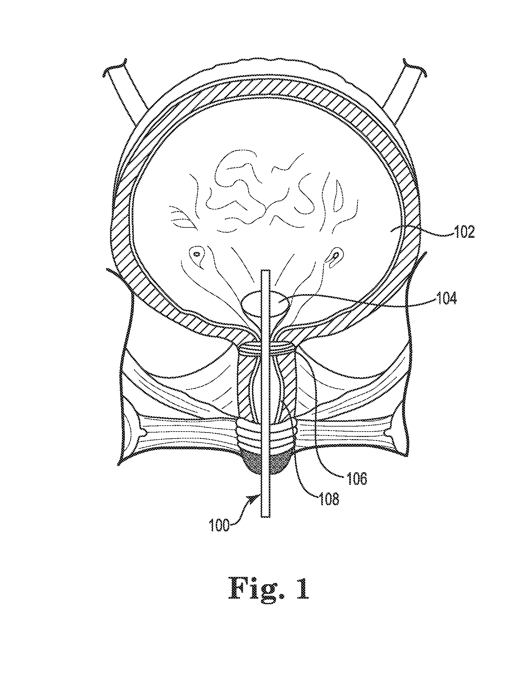 Pressure sensing catheter system