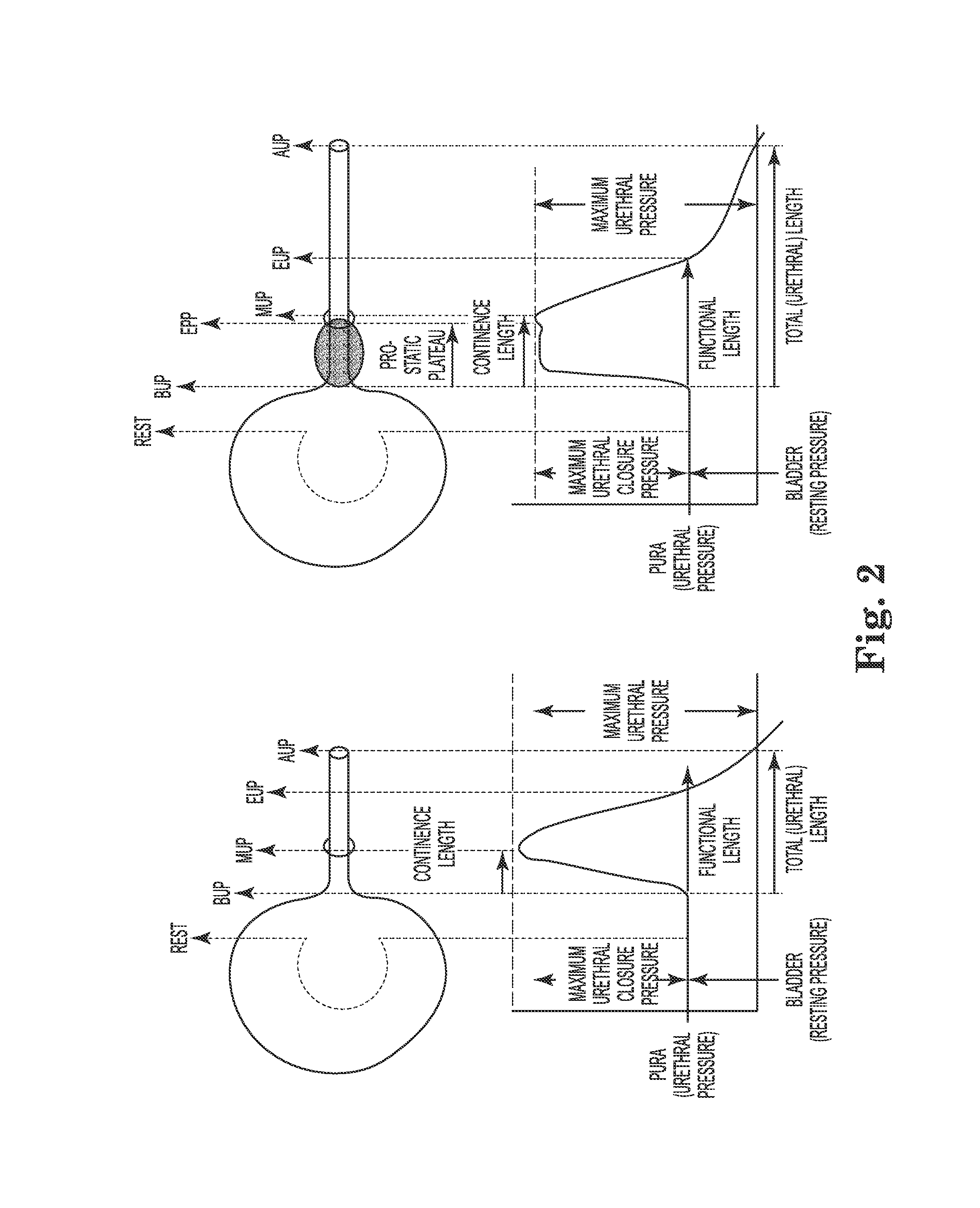 Pressure sensing catheter system