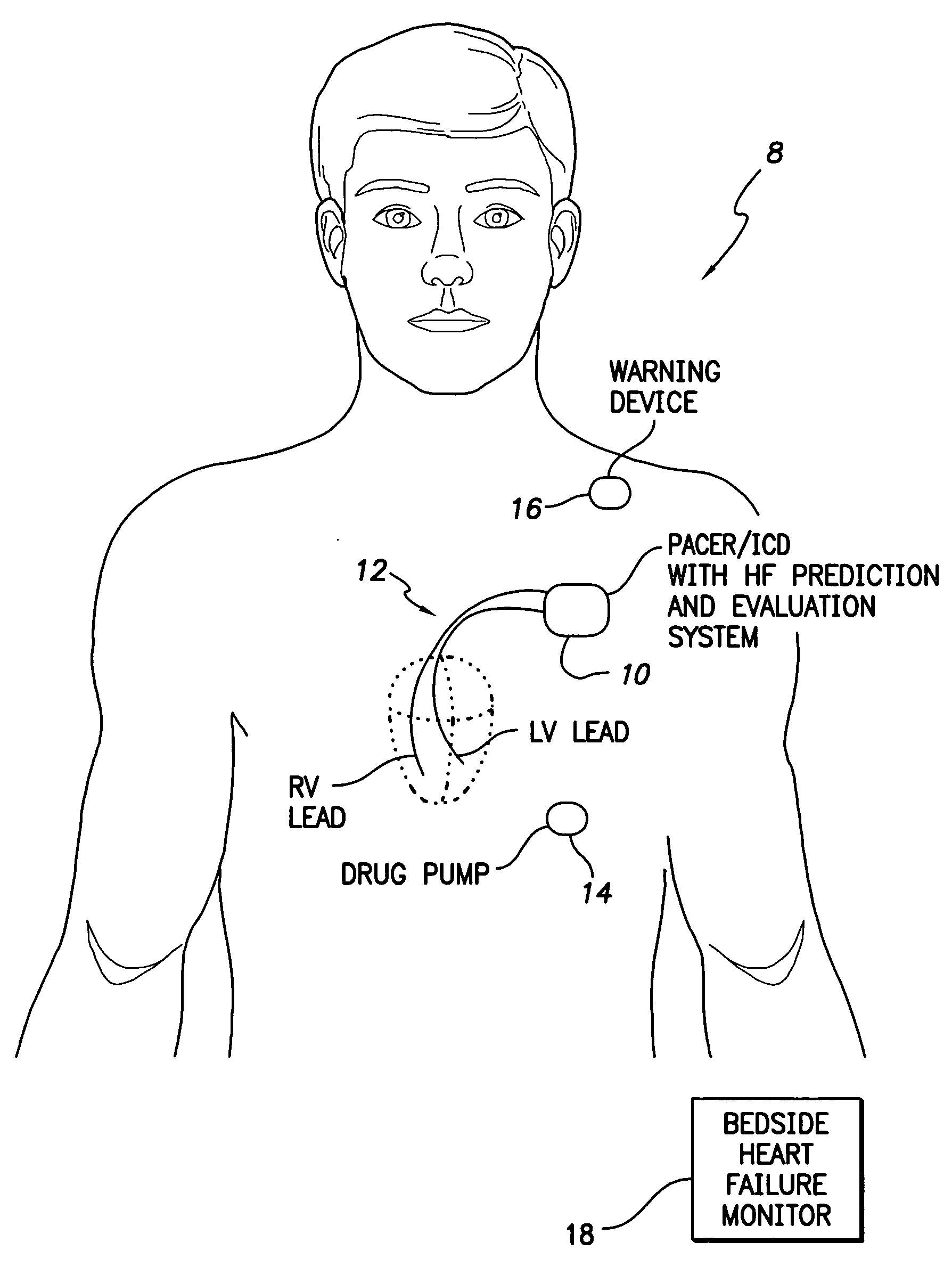 System and method for predicting a heart condition based on impedance values using an implantable medical device