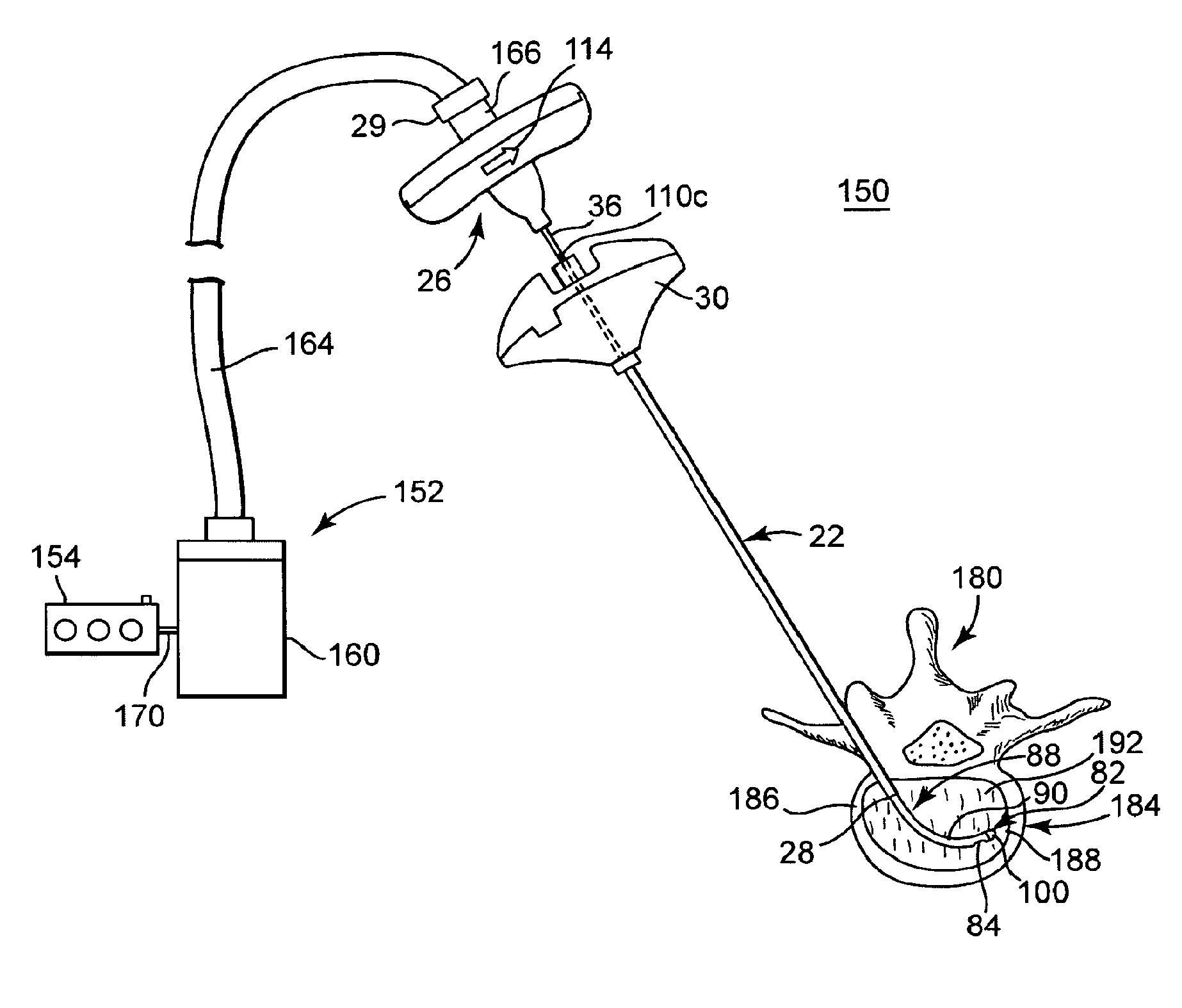 Multistate-curvature device and method for delivering a curable material into bone