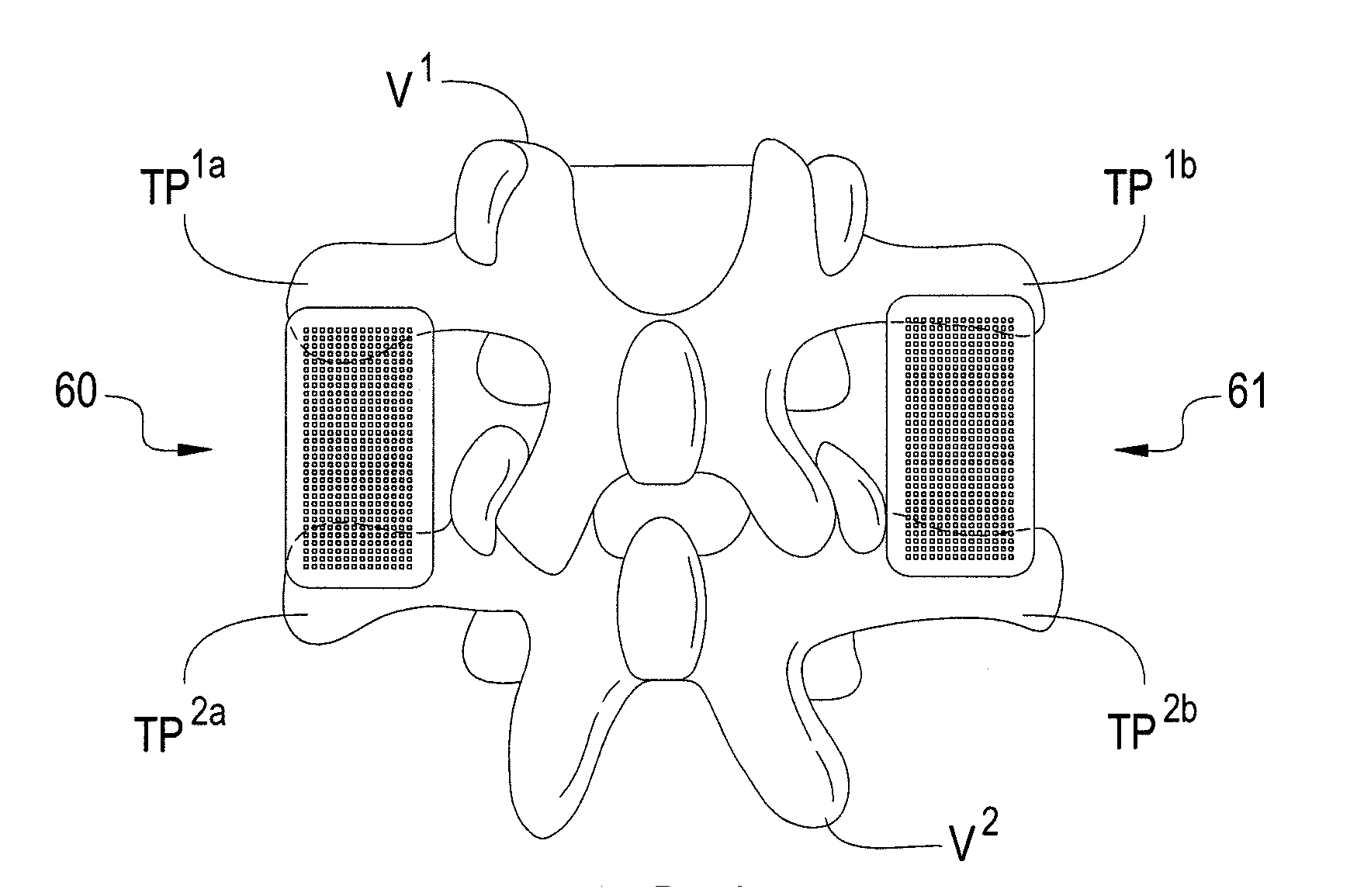 Osteoconductive Implants and Methods of Using Same