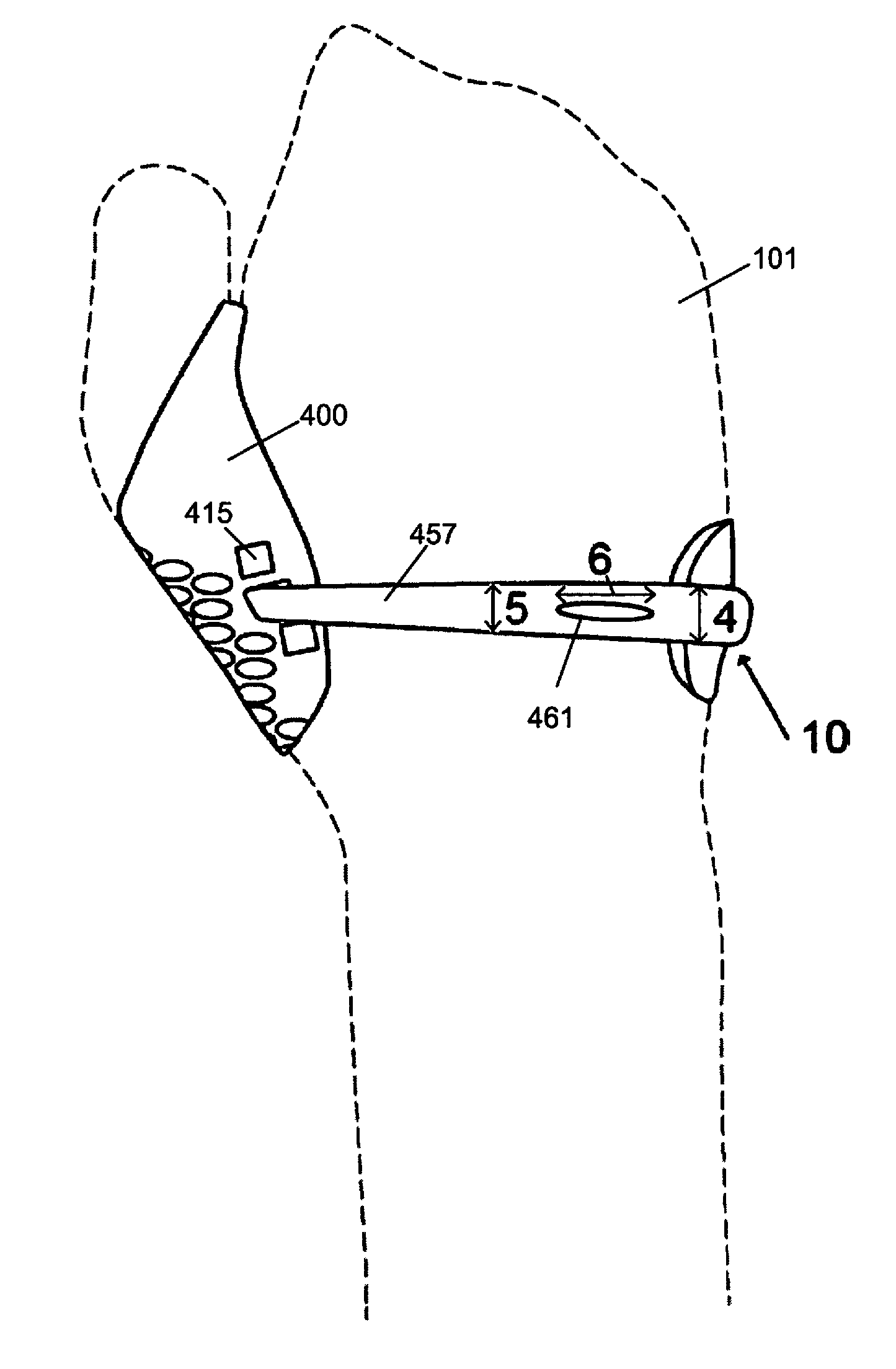 Conformal hand brace