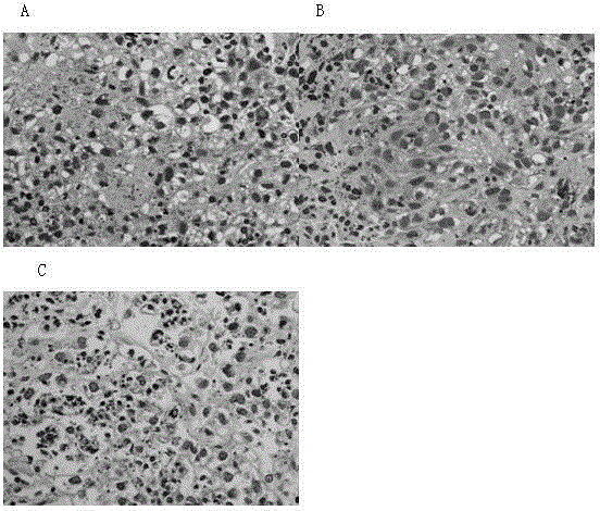 Ovarian cancer tissue 3D cultivation method and application of 3D cultivated cancer tissue to efficacy evaluation