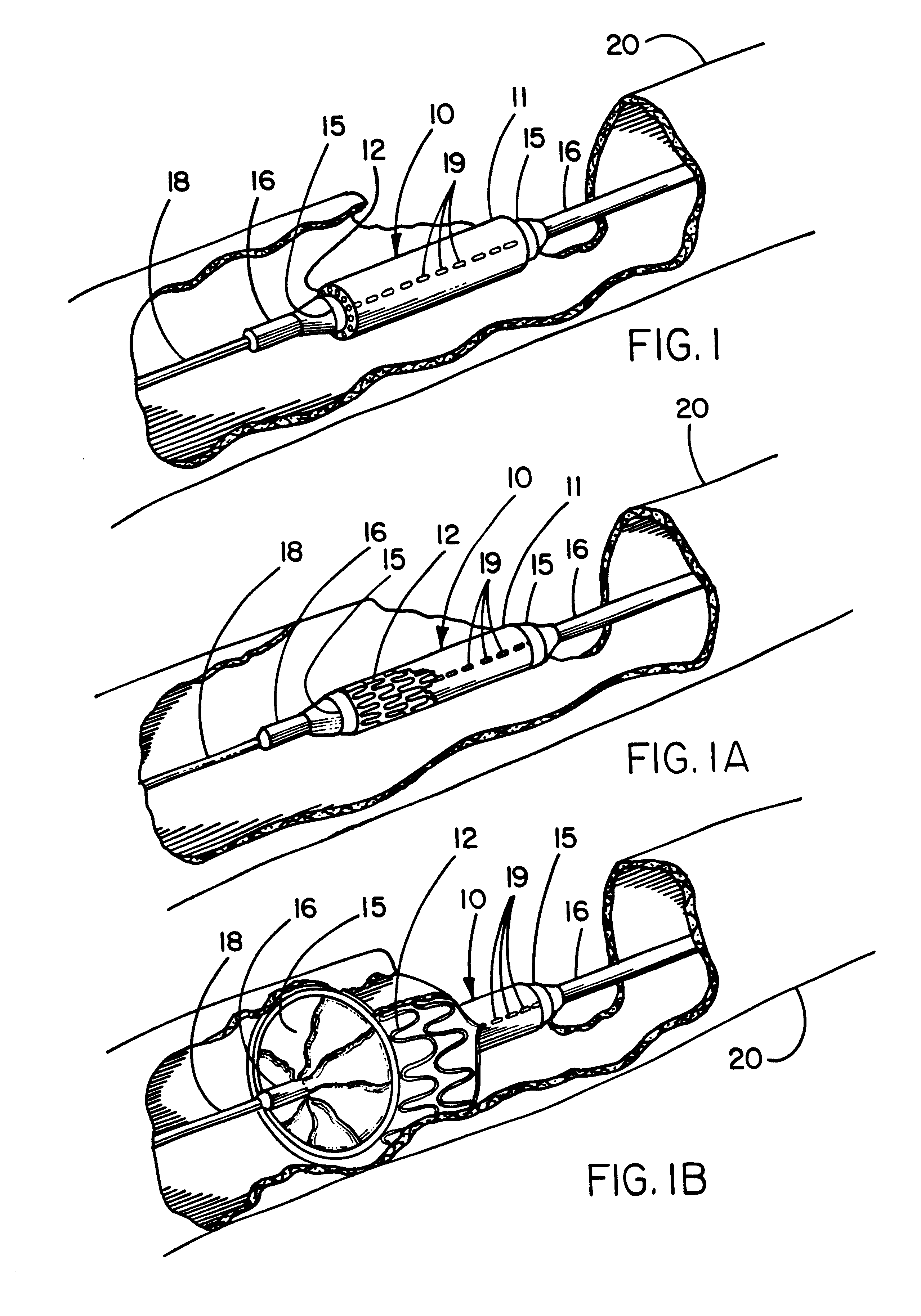 Deployment system for intraluminal devices