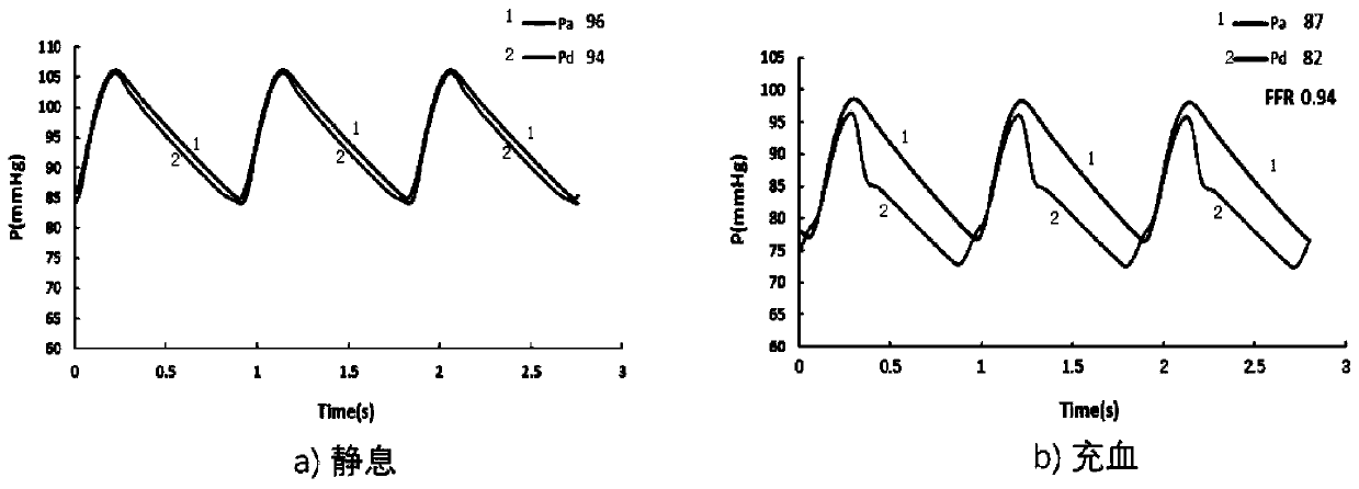 FFR rapid calculation system model based on zero-dimensional hemodynamic model