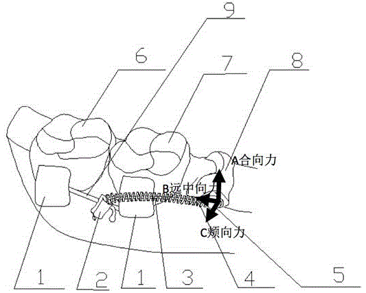 Underjaw premolar teeth residual root traction device