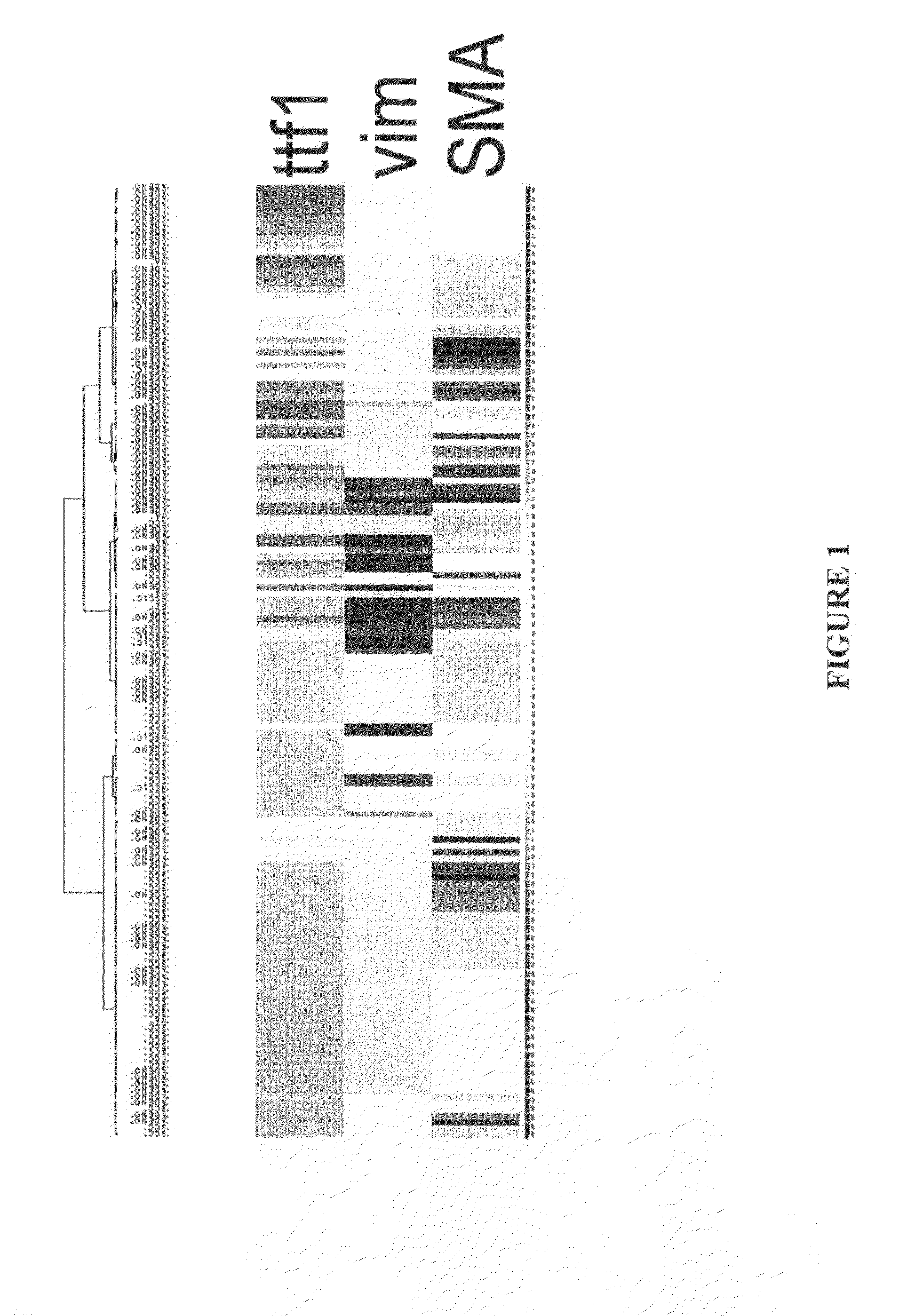 Molecular diagnosis and typing of lung cancer variants