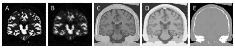 Non-local mean-guided partial volume correction method for PET images constrained by MR structural information