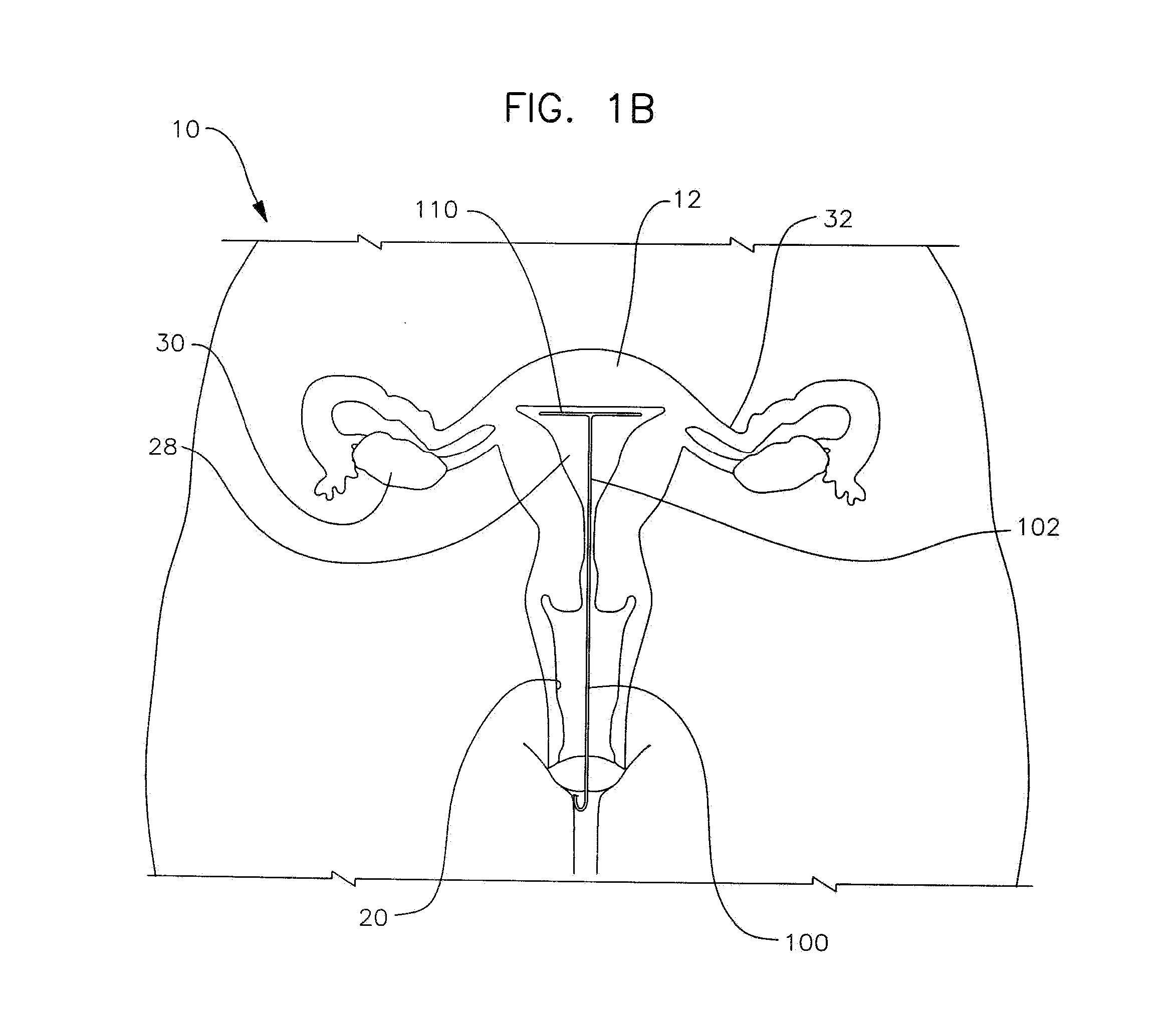 Apparatus and method for the treatment of abnormal uterine bleeding