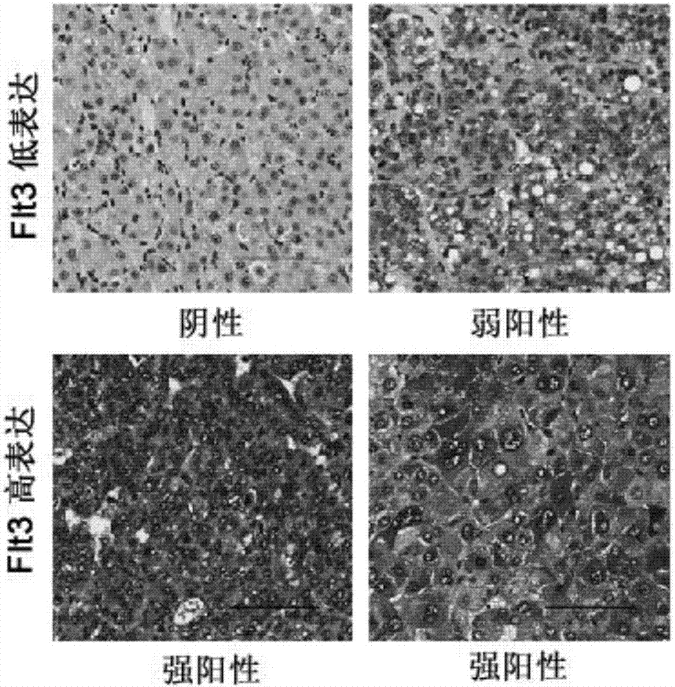 Application of flt3 protein in the preparation of a kit for evaluating the efficacy of sorafenib in liver cancer