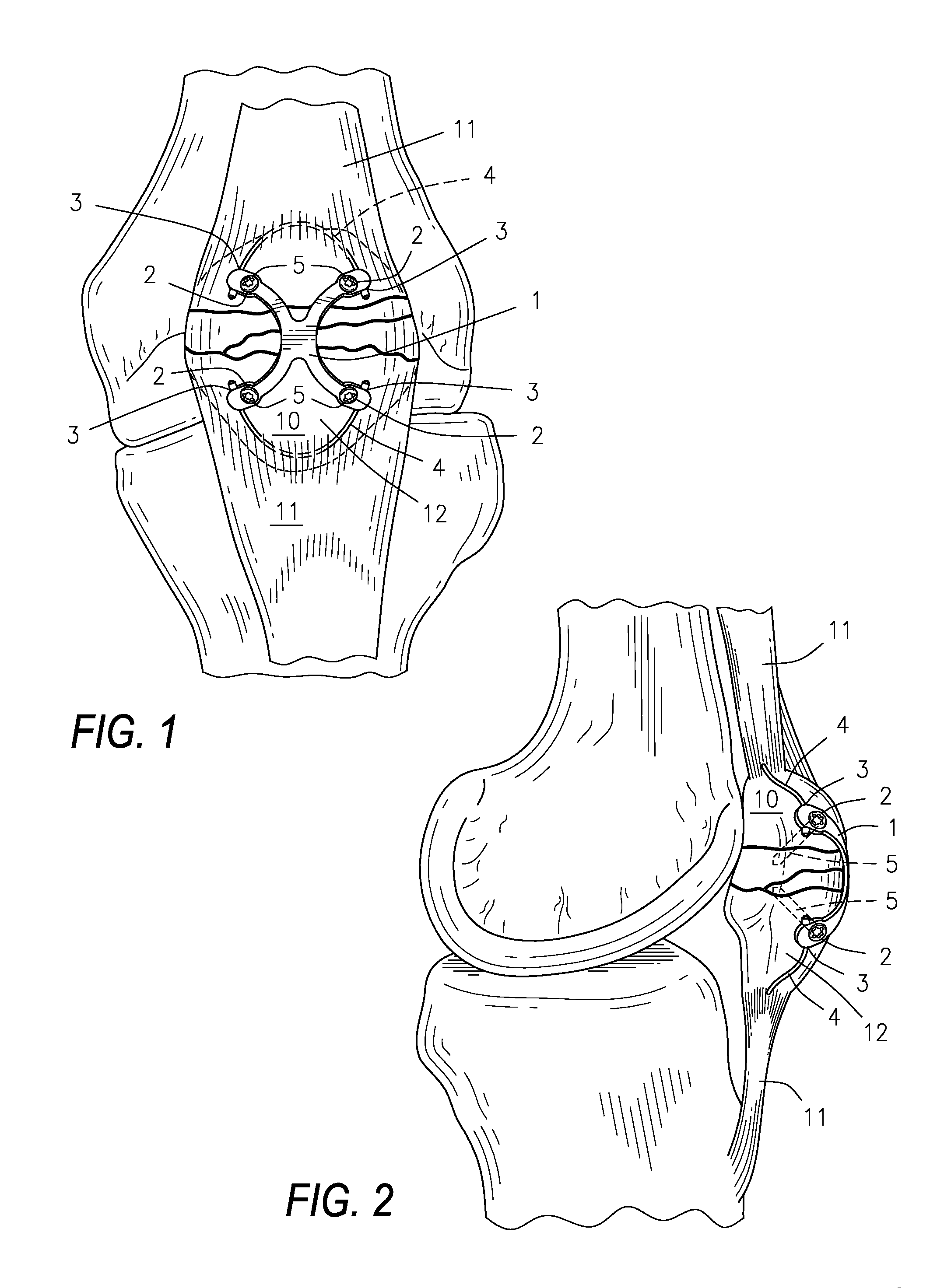 Low profile periarticular tension band plating system with soft tissue neutralization cable tunnel/channel