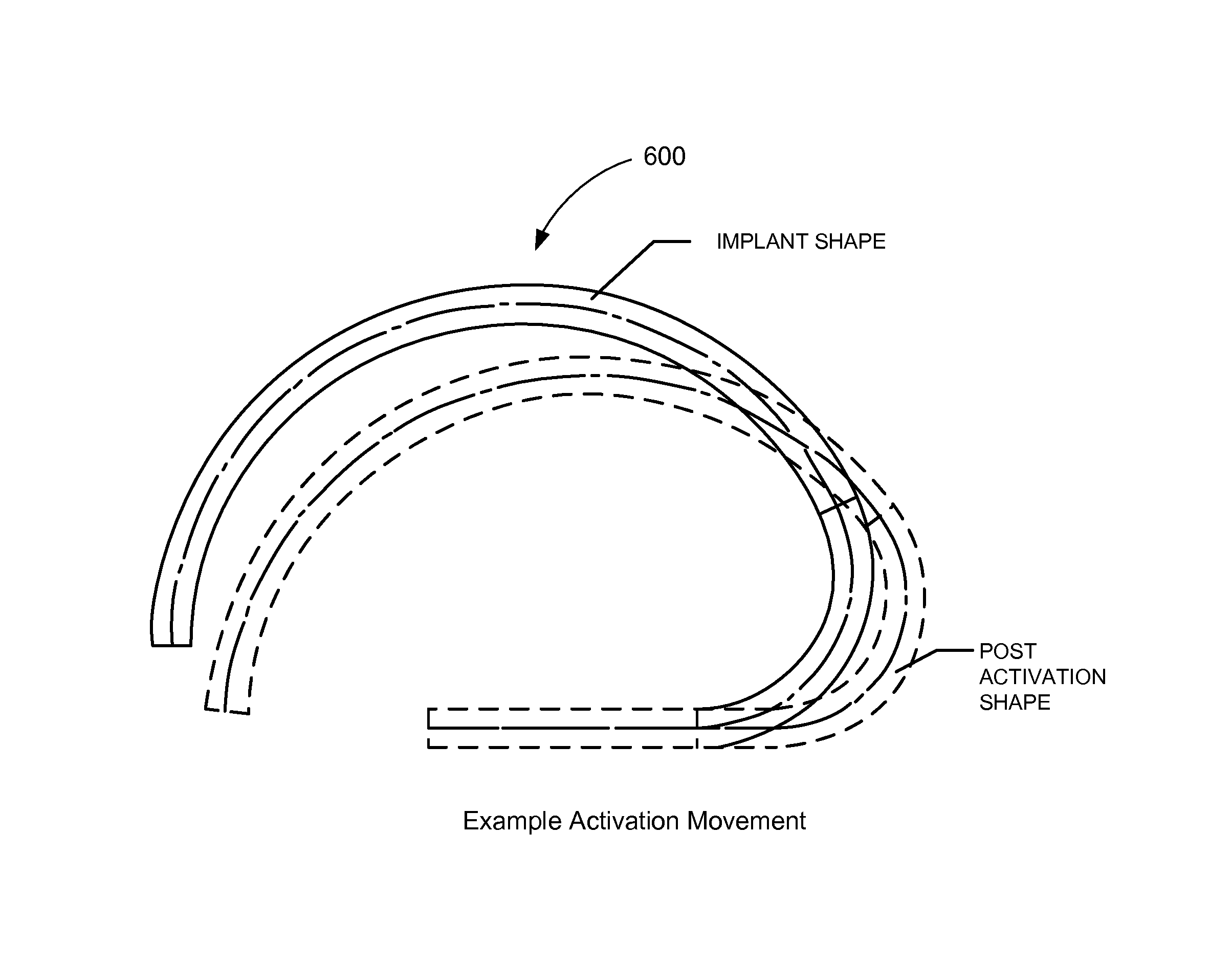 Adjustable tricuspid ring