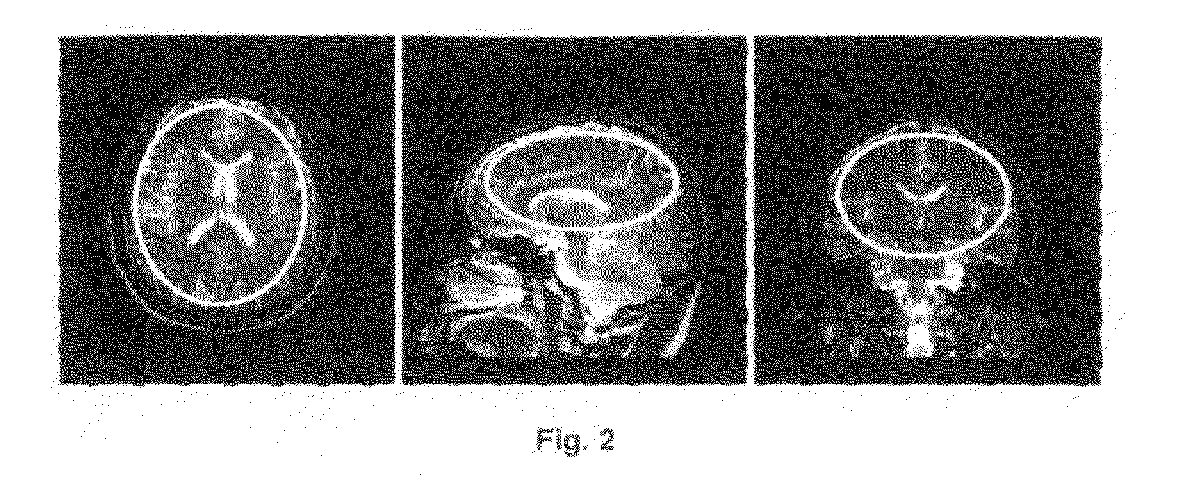 Method of Utilization of High Dielectric Constant (HDC) Materials for Reducing SAR and Enhancing SNR in MRI