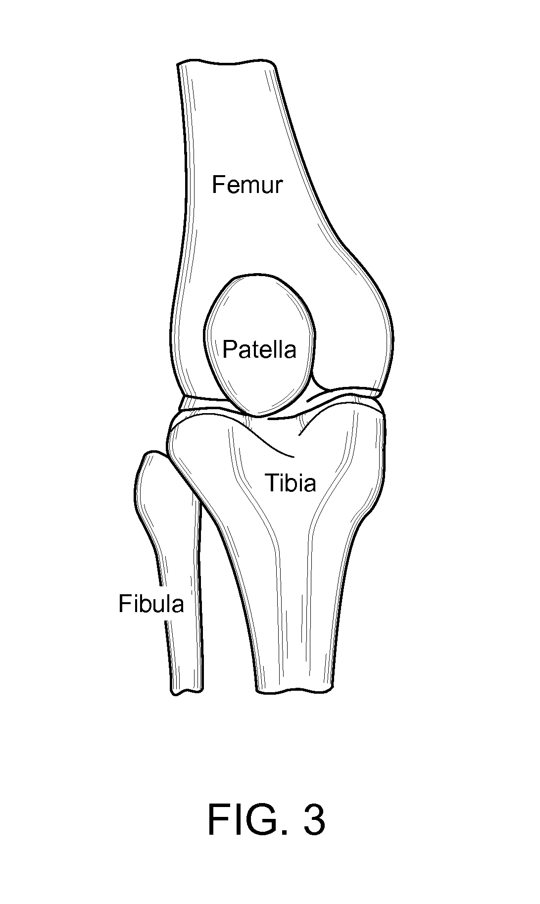 Method and Apparatus for Force Redistribution in Articular Joints