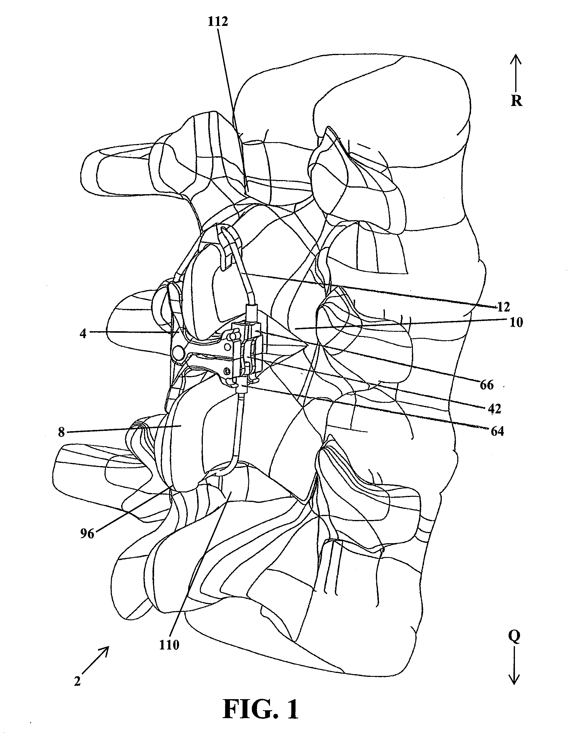 Intervertebral Implant Devices and Methods for Insertion Thereof