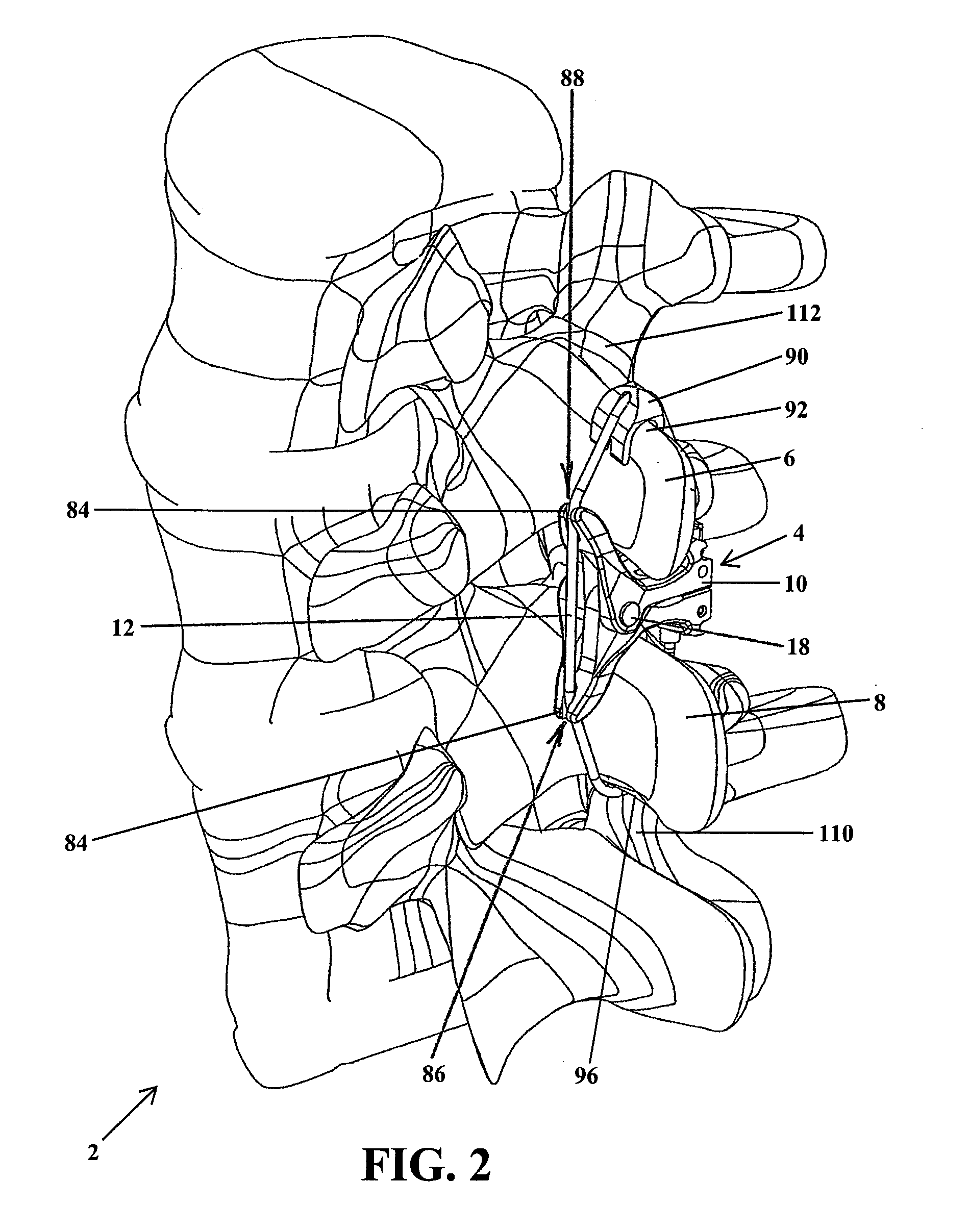 Intervertebral Implant Devices and Methods for Insertion Thereof