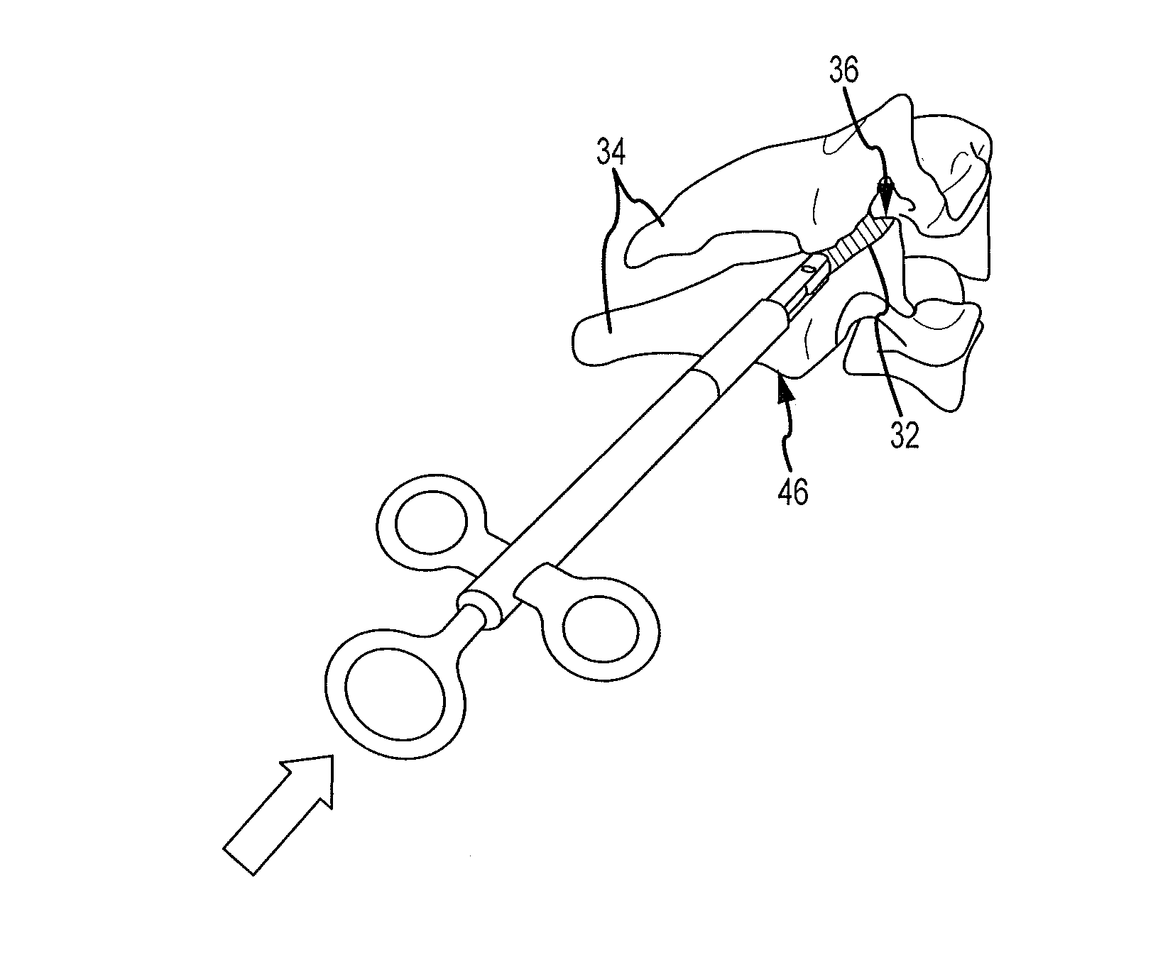 Cervical distraction/implant delivery device