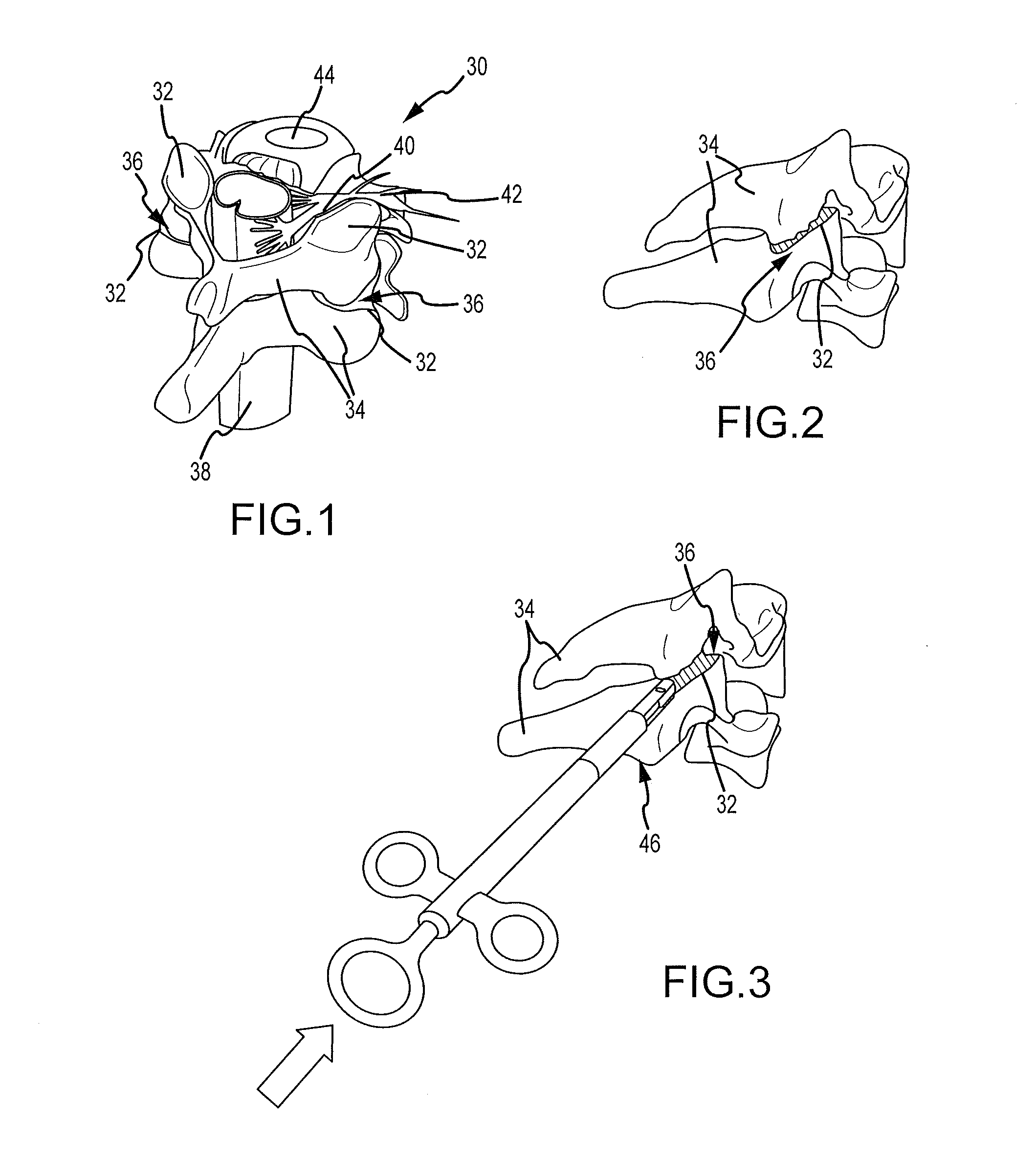 Cervical distraction/implant delivery device