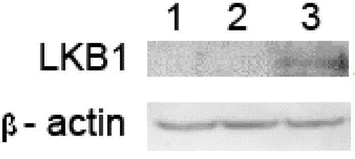 Cationic liposome compound of cancer suppressor gene LKB1 eukaryotic expression plasmid as well as preparation method and anti-tumor effect thereof