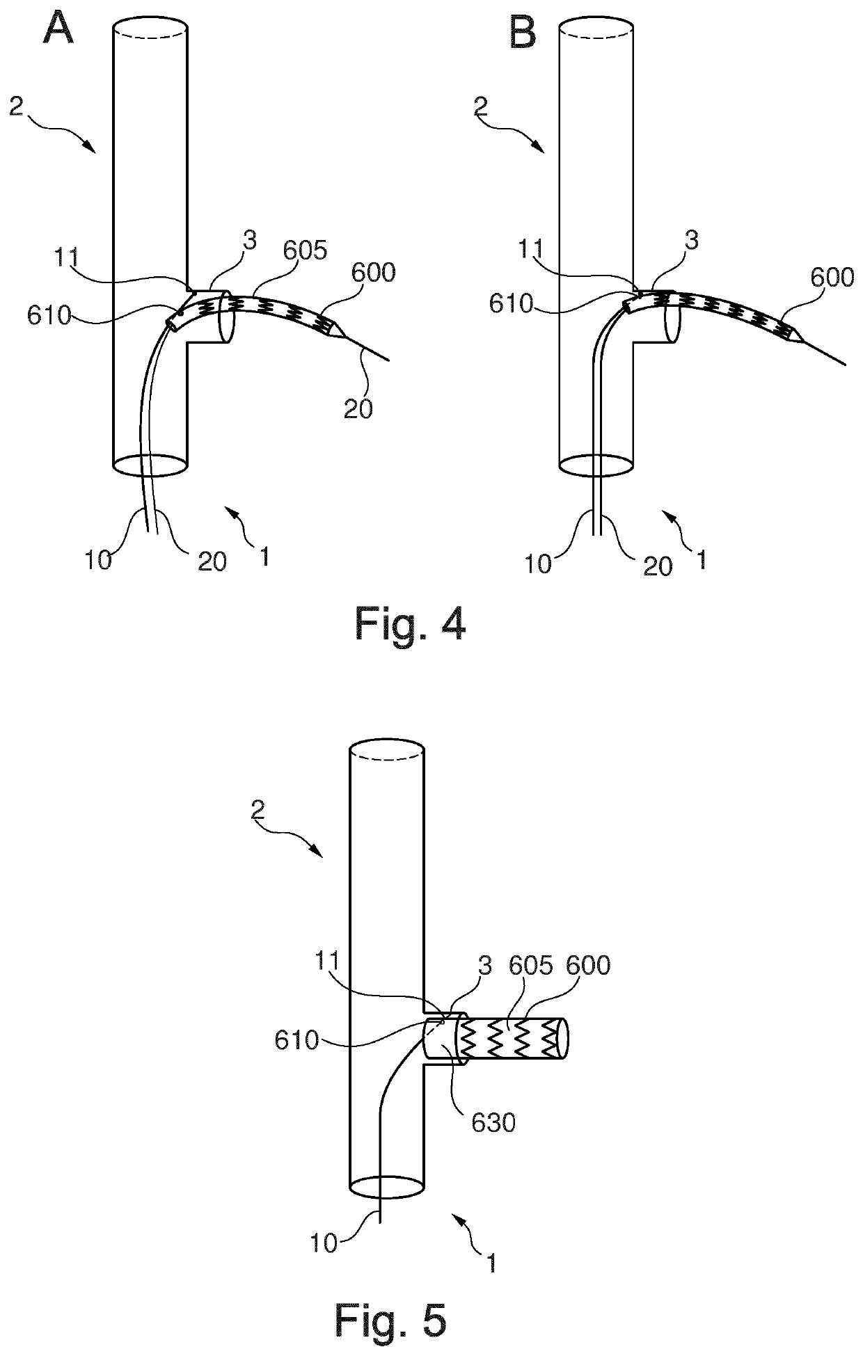 Stent-graft prosthesis, system and method for improved delivery of a stent-graft prosthesis