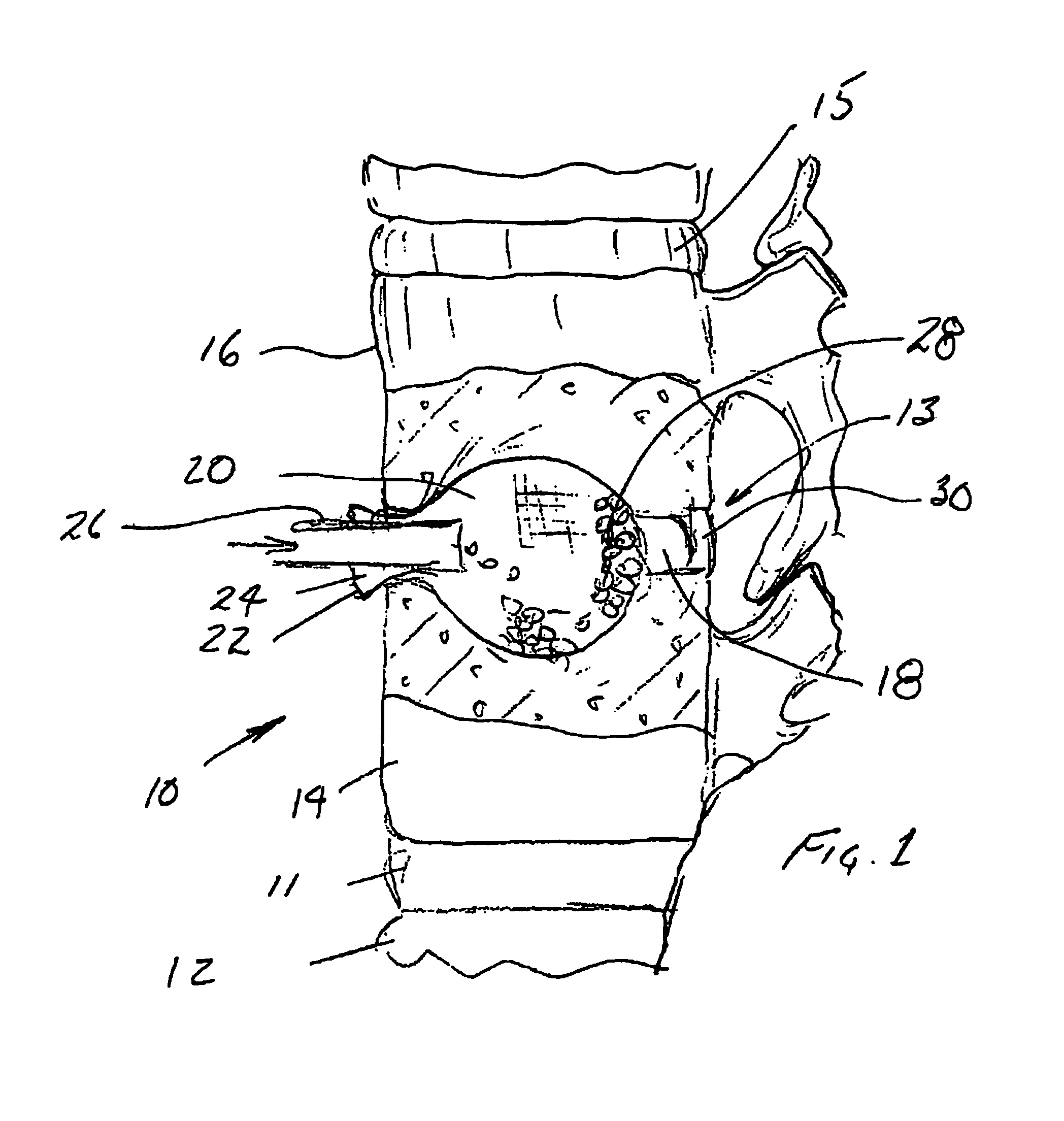 Packable ceramic beads for bone repair