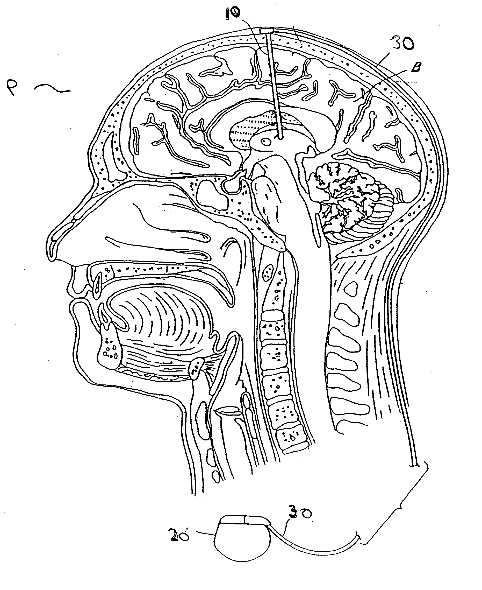 Modulation of the pain circuitry to affect chronic pain