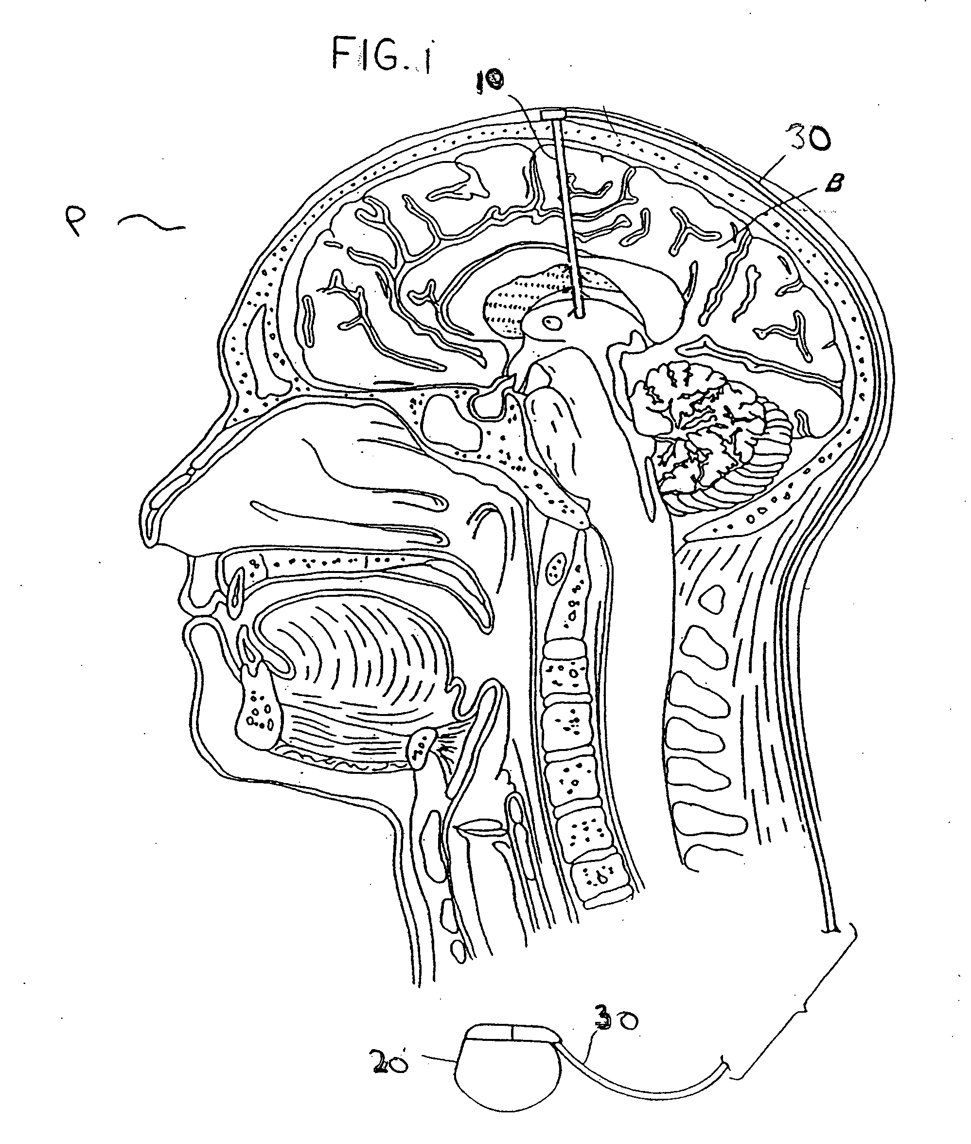 Modulation of the pain circuitry to affect chronic pain