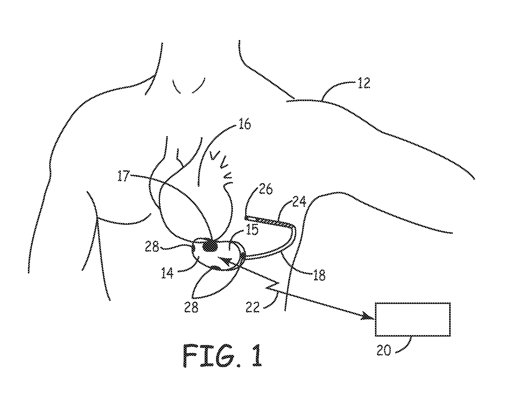 Method and apparatus for verifying a determined cardiac event in a medical device based on detected variation in hemodynamic status