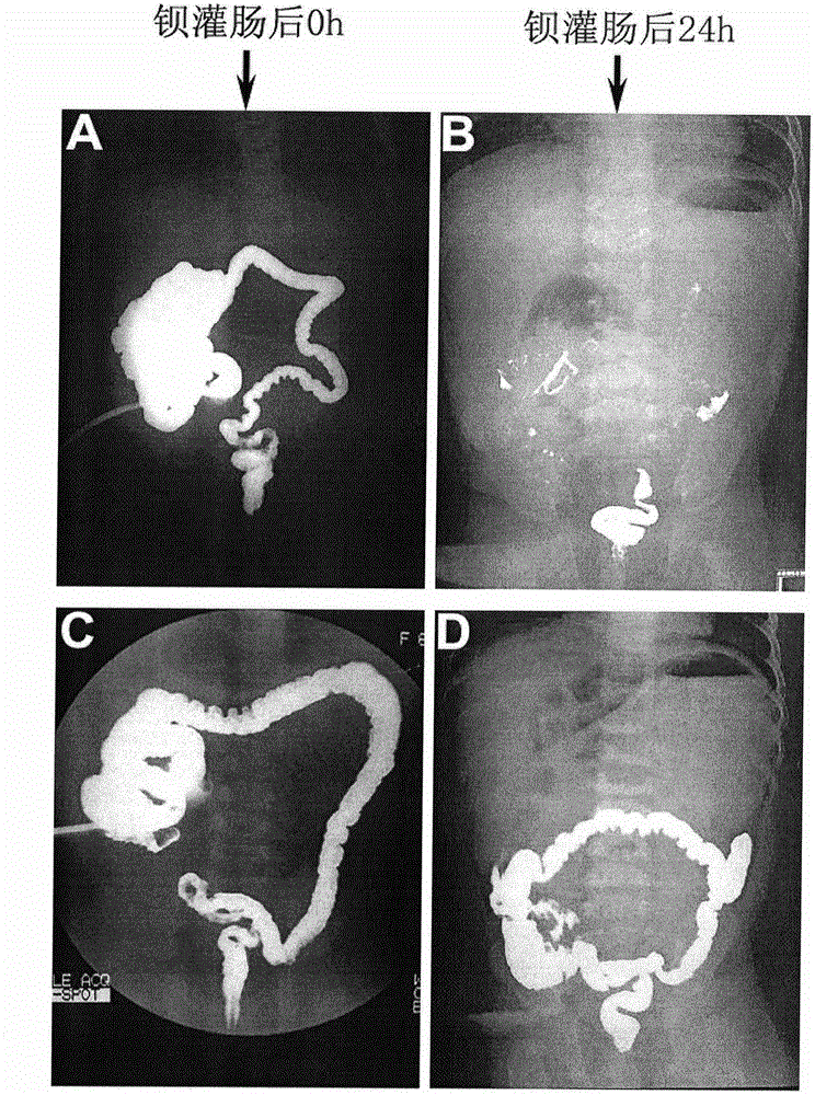 Single-nucleotide polymorphism marker relevant to occurrence of congenital megacolon of Chinese population and application of single-nucleotide polymorphism marker