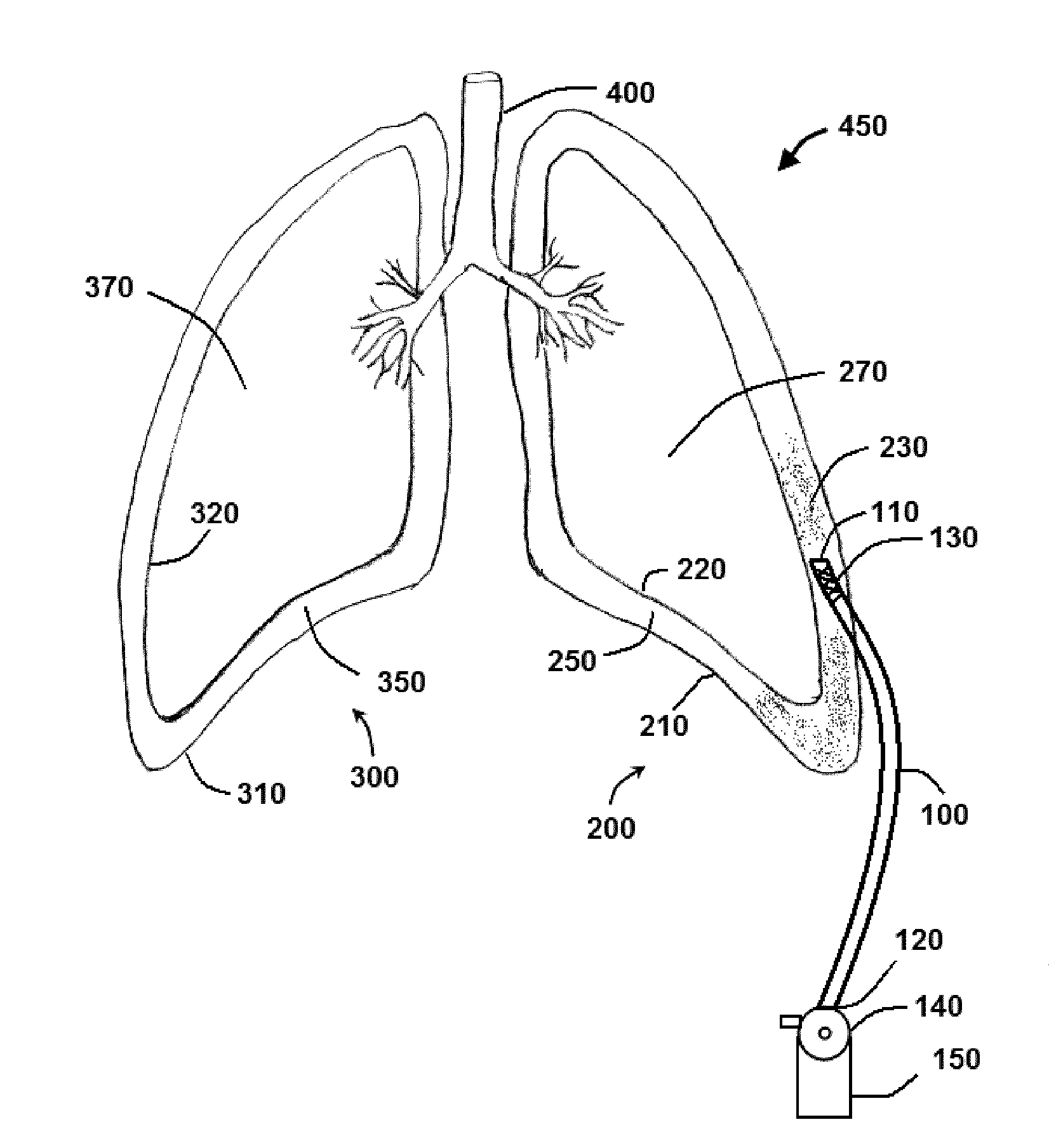 Method and System for Sustained-Release of Sclerosing Agent