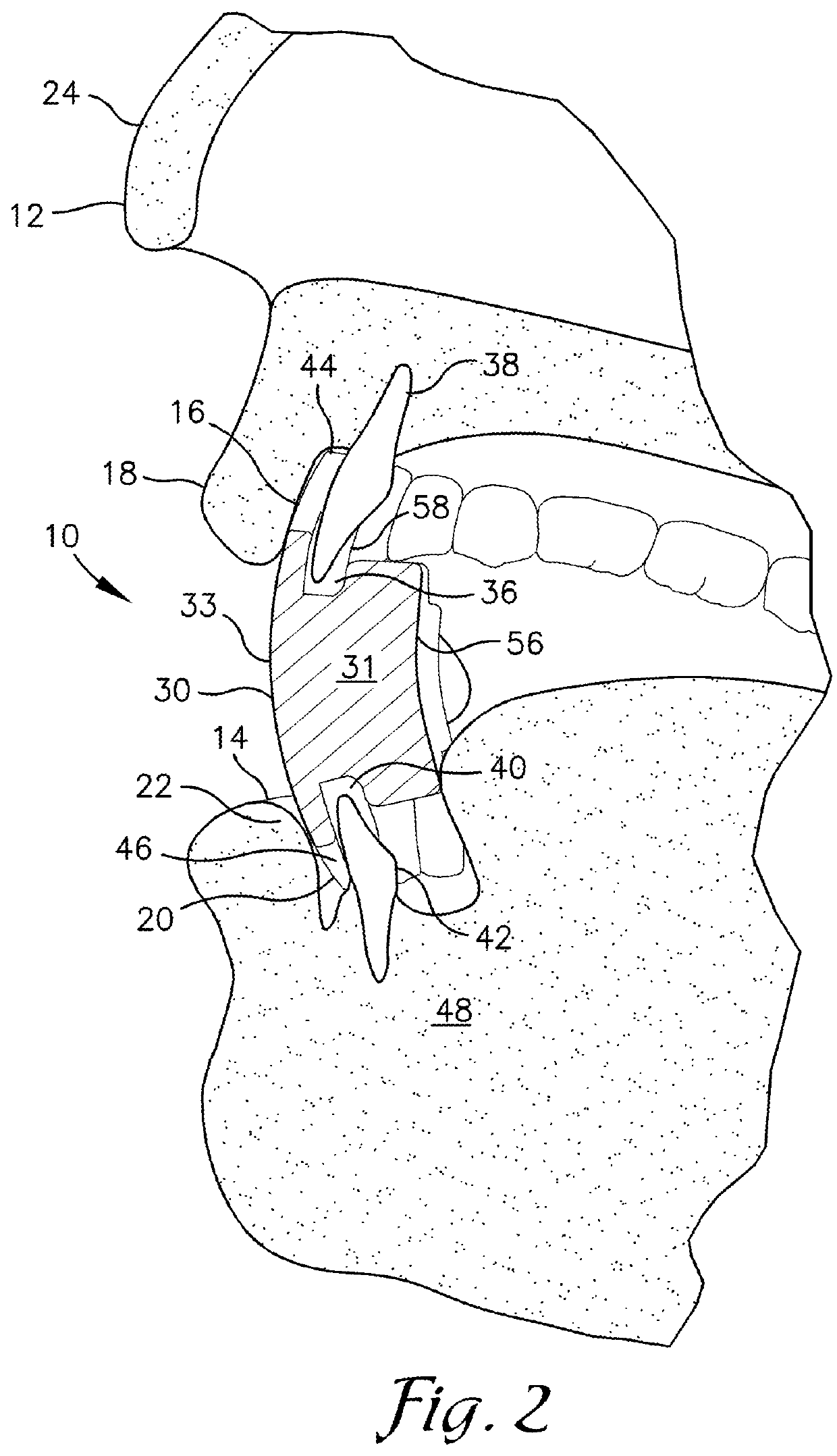 Snore reducing mouthpiece