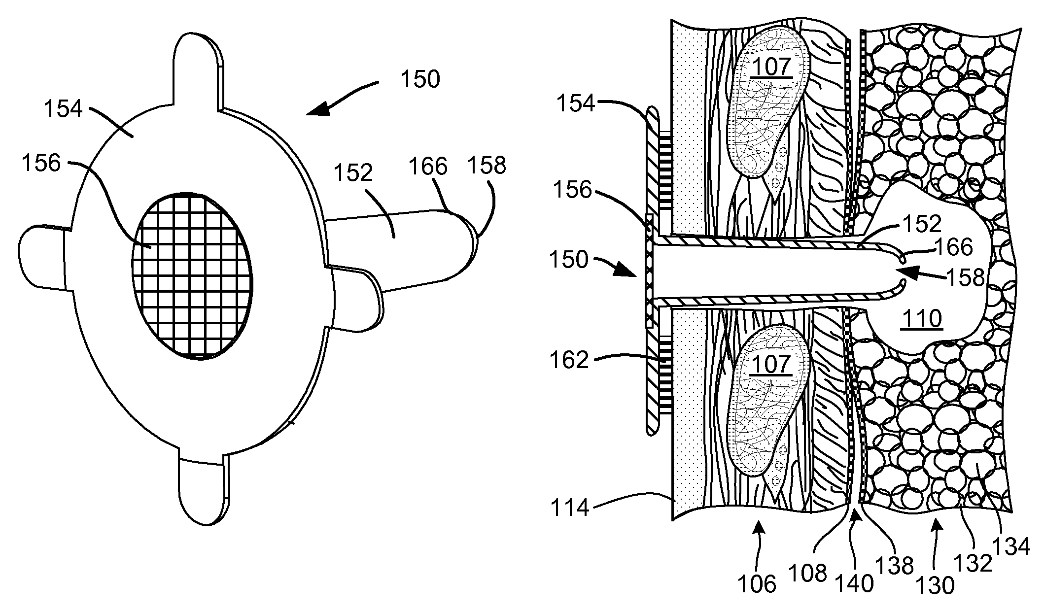 Methods and devices for assessment of pneumostoma function