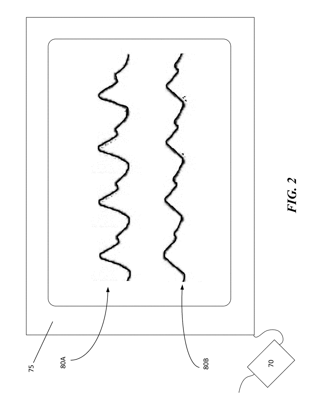 Sampling Port for Hemodynamic Monitoring Systems